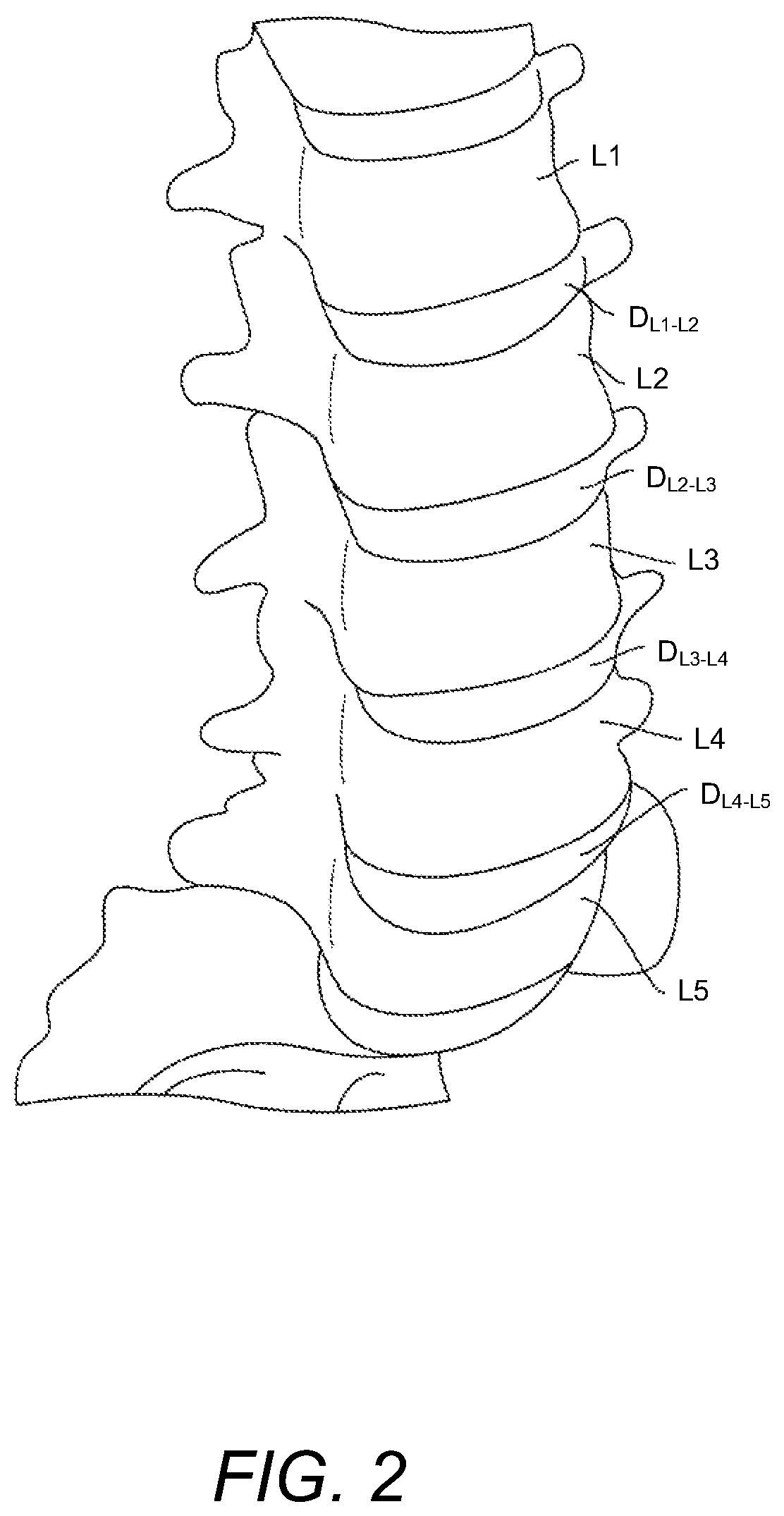 Patent US12102537 Figure 2 – Minimally invasive expandable intervertebral fusion implant