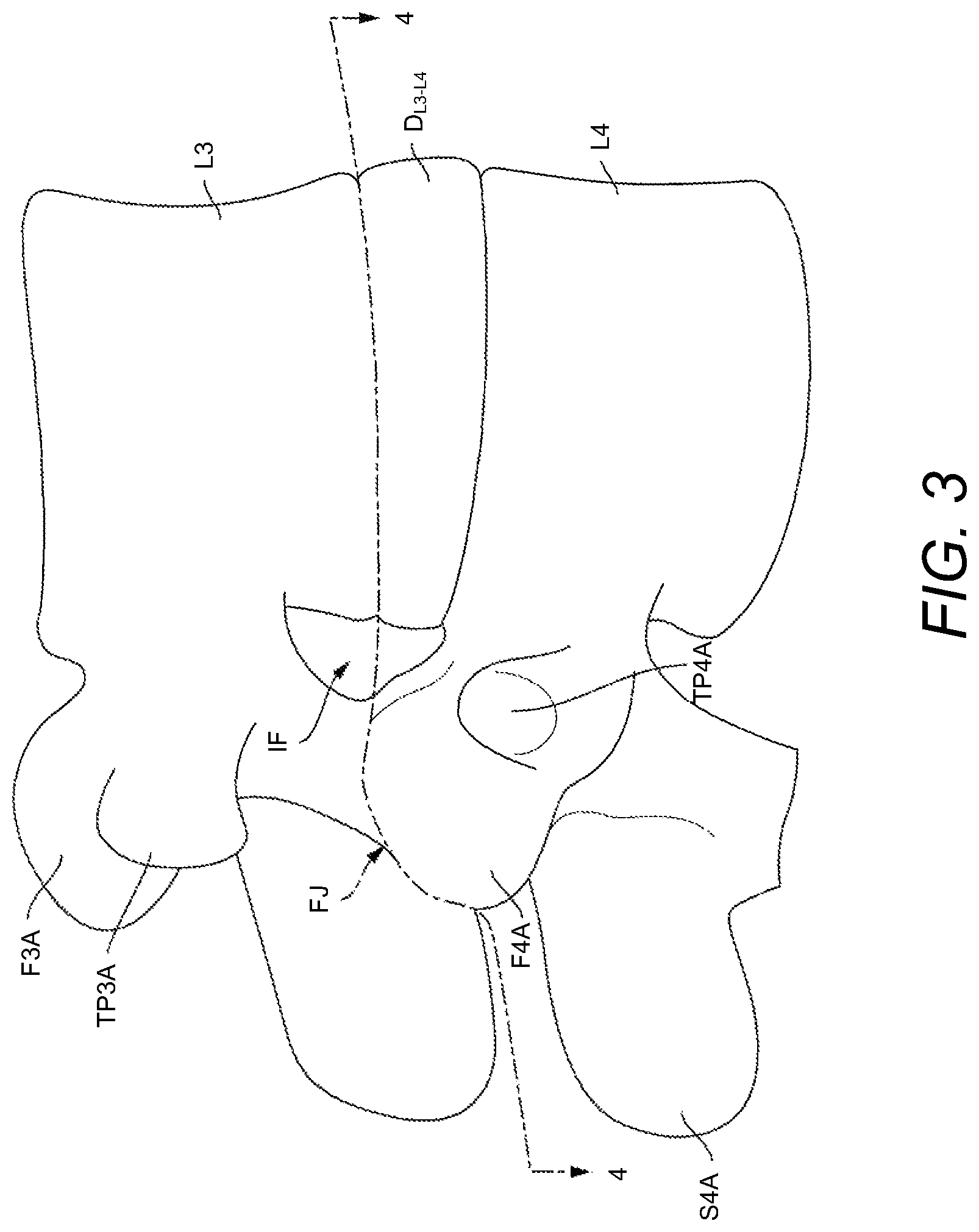 Patent US12102537 Figure 3 – Minimally invasive expandable intervertebral fusion implant