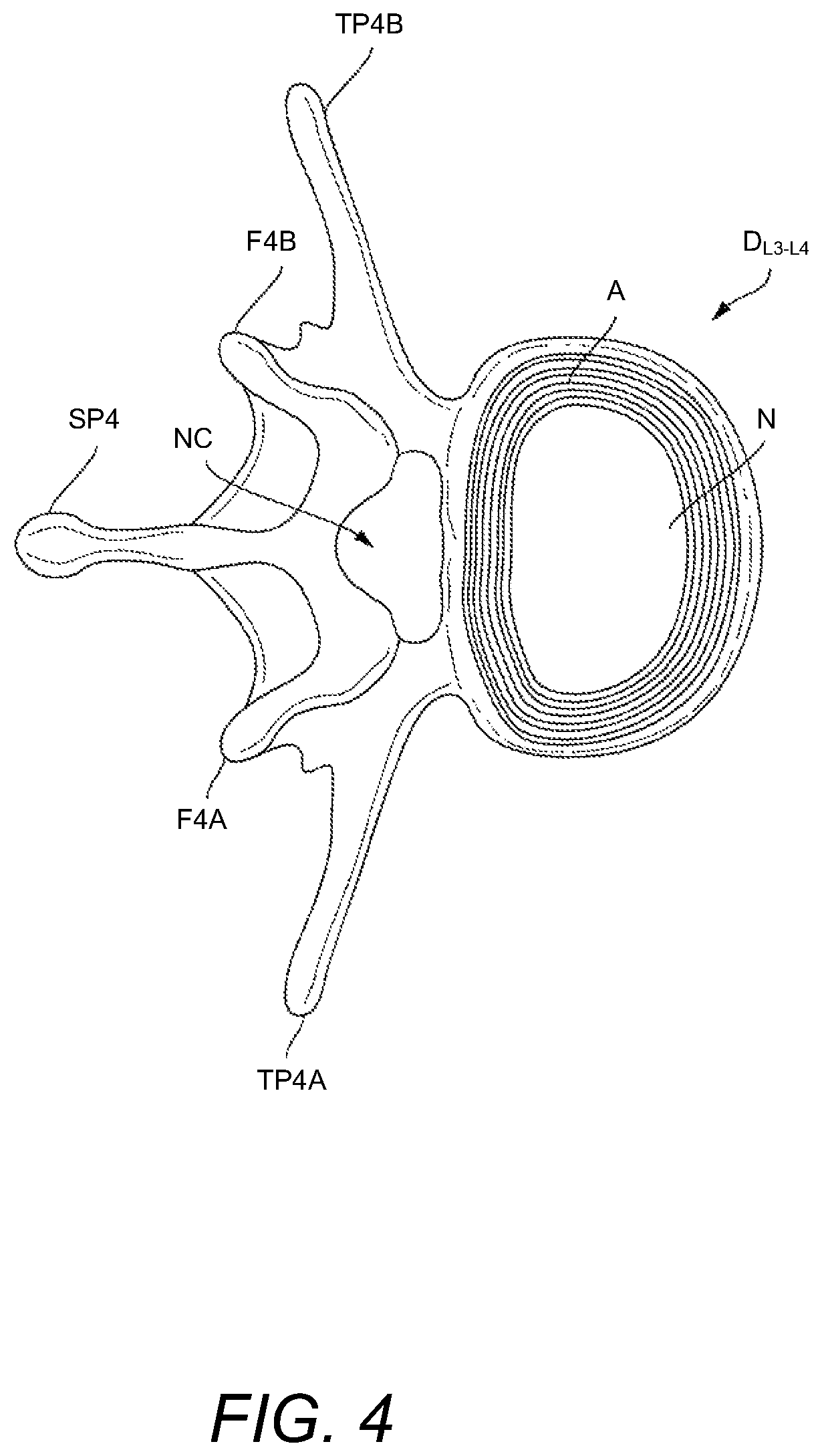 Patent US12102537 Figure 4 – Minimally invasive expandable intervertebral fusion implant