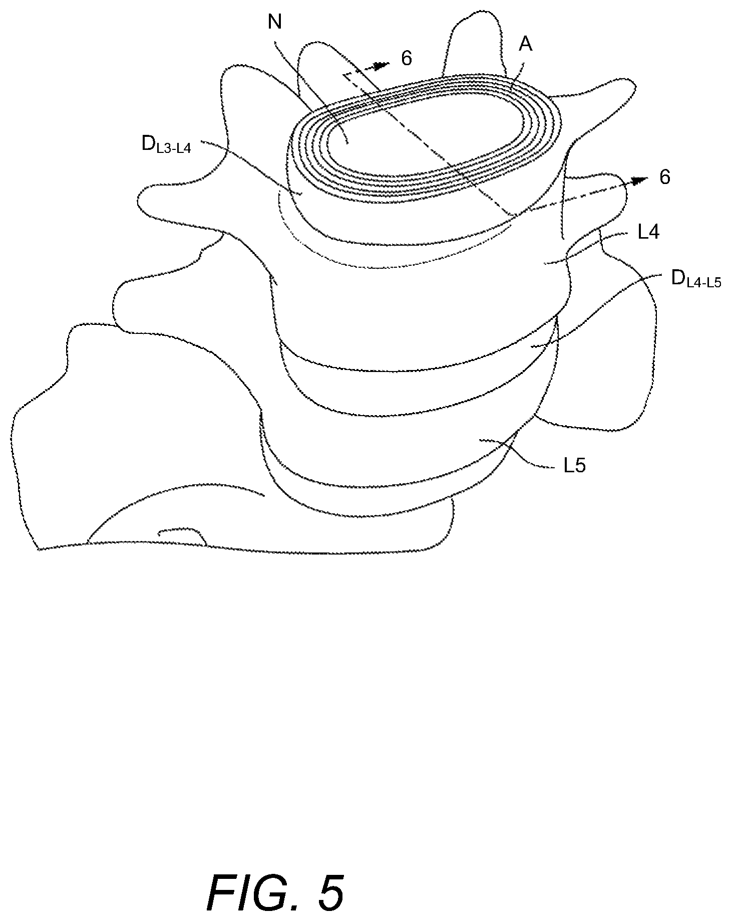 Patent US12102537 Figure 5 – Minimally invasive expandable intervertebral fusion implant