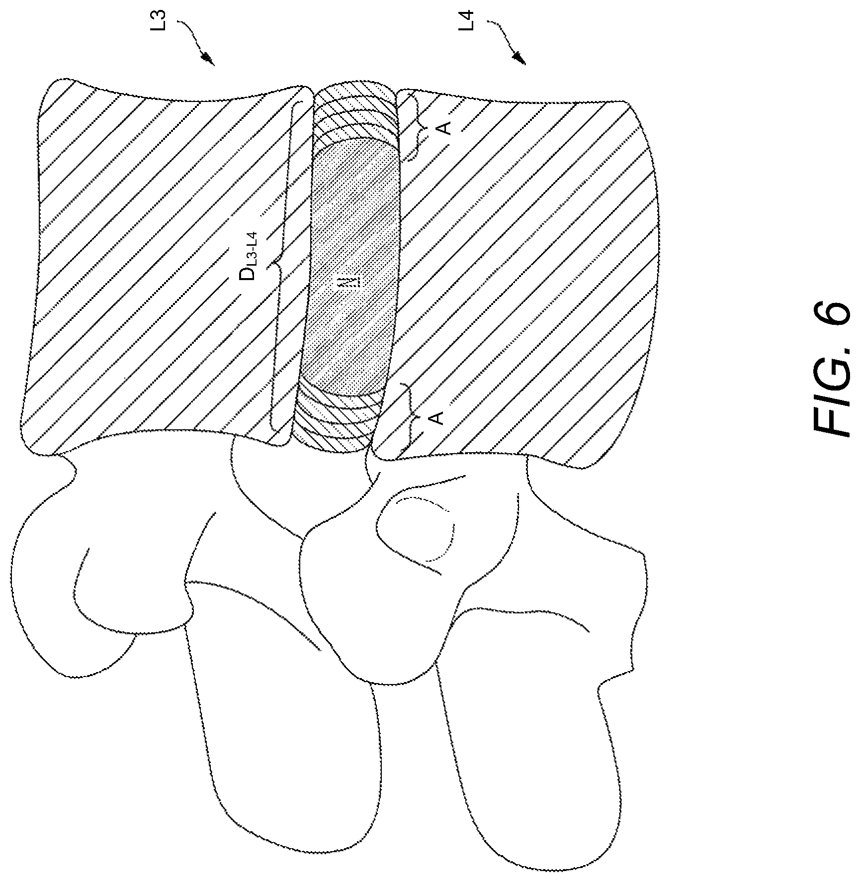 Patent US12102537 Figure 6 – Minimally invasive expandable intervertebral fusion implant