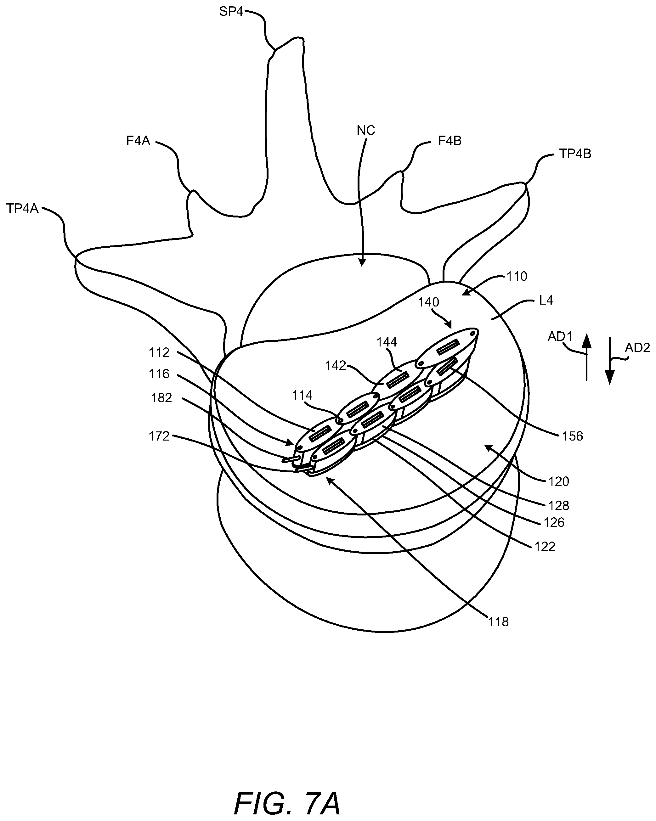 Patent US12102537 Figure 7 – Minimally invasive expandable intervertebral fusion implant