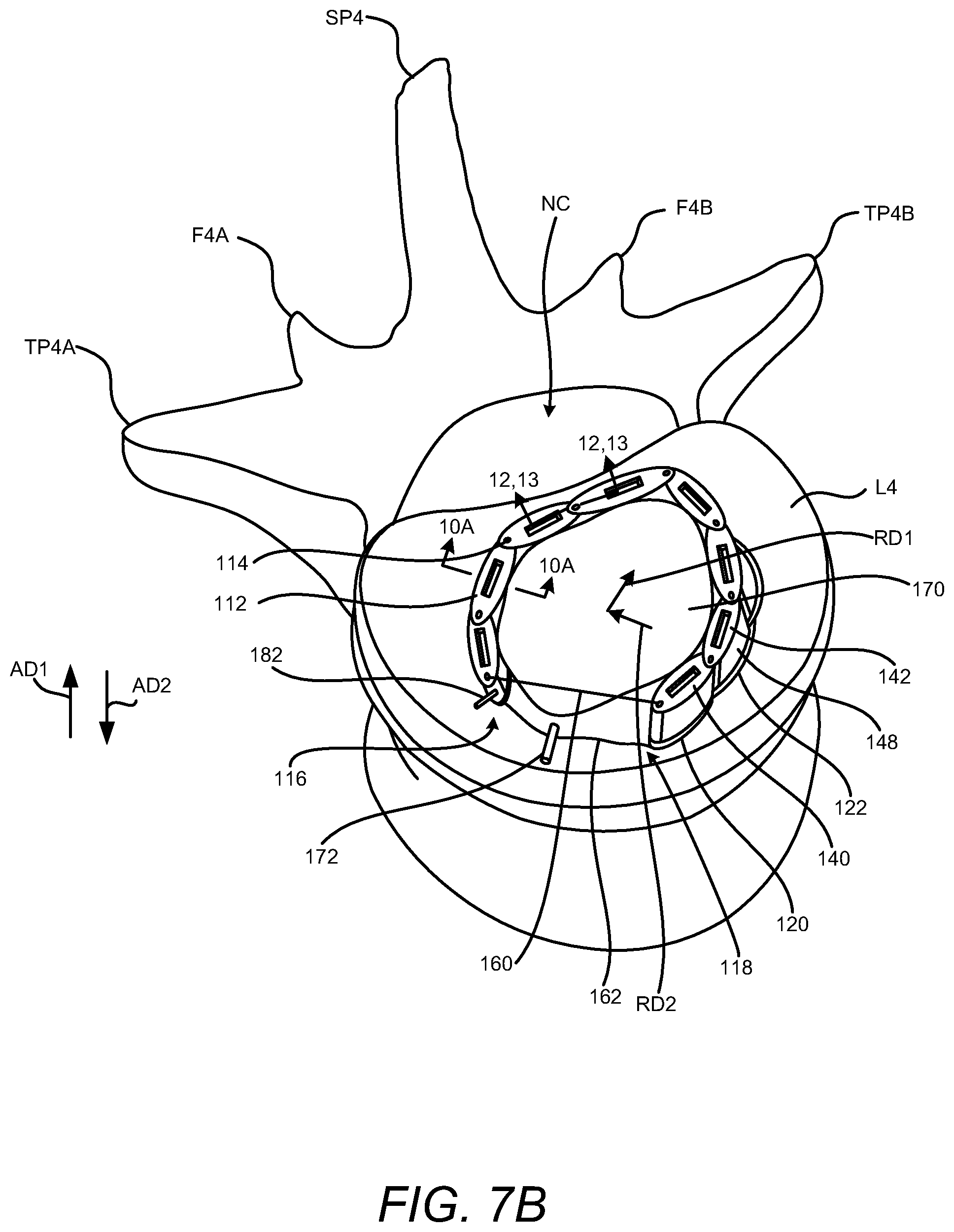 Patent US12102537 Figure 8 – Minimally invasive expandable intervertebral fusion implant