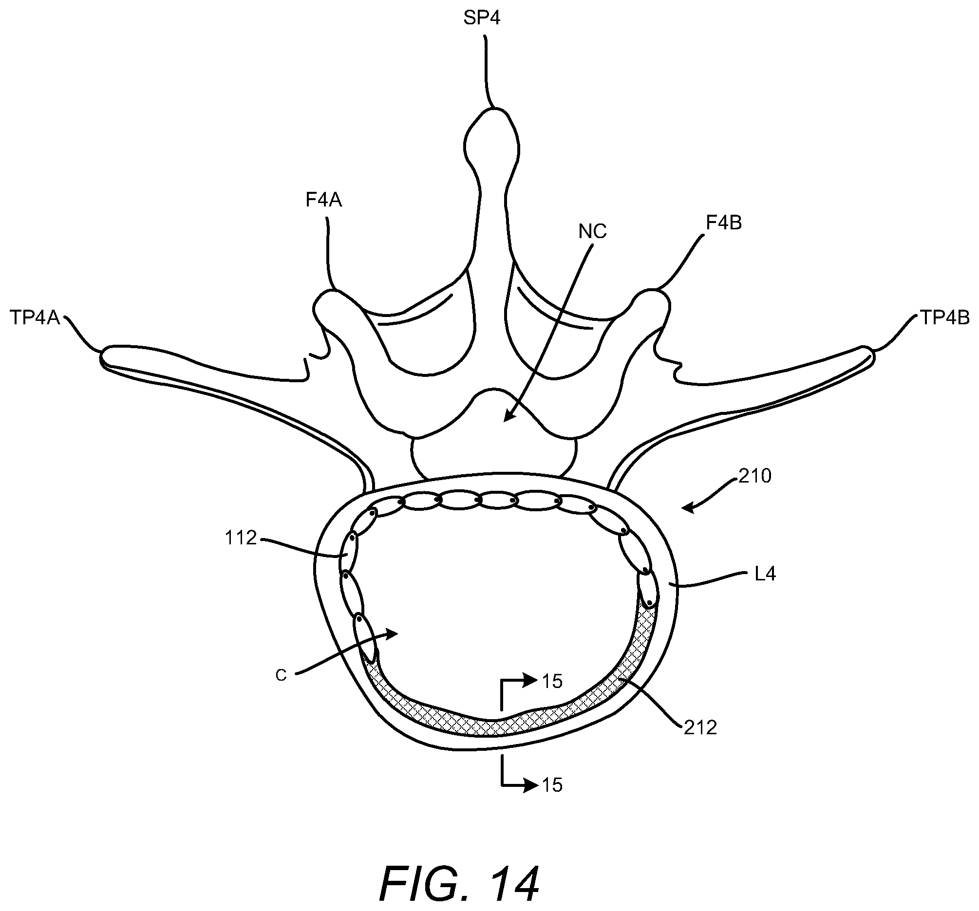 Patent US12102537 Figure 14 – Minimally invasive expandable intervertebral fusion implant