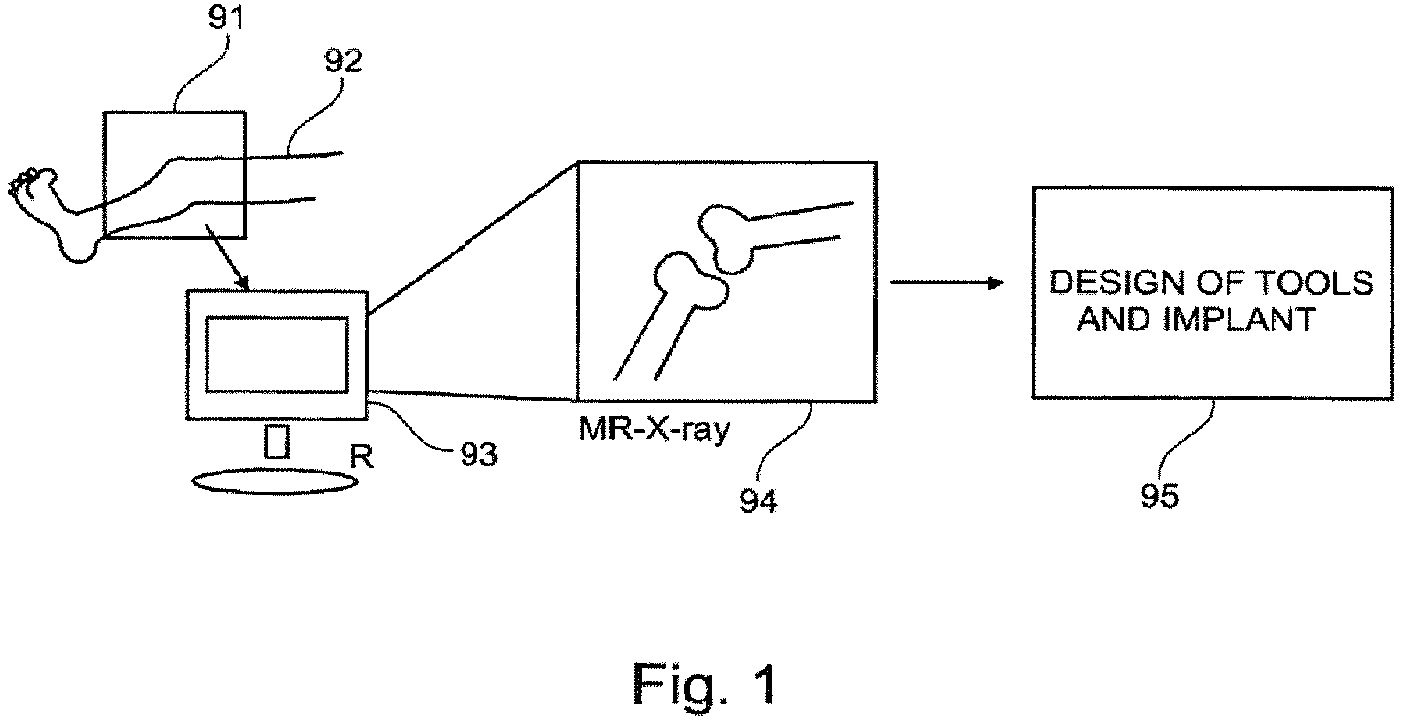 Patent US12102540 — System of designing a guide tool and/or surgical kit tools and/or an implant comprising a positioning mark — Figure 1