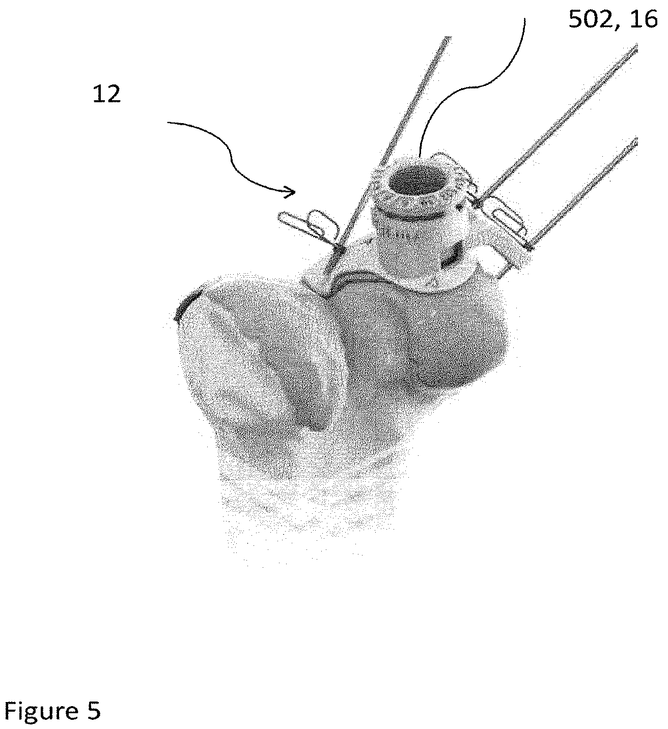 Patent US12102540 Figure 5 – System of designing a guide tool and/or surgical kit tools and/or an implant comprising a positioning mark