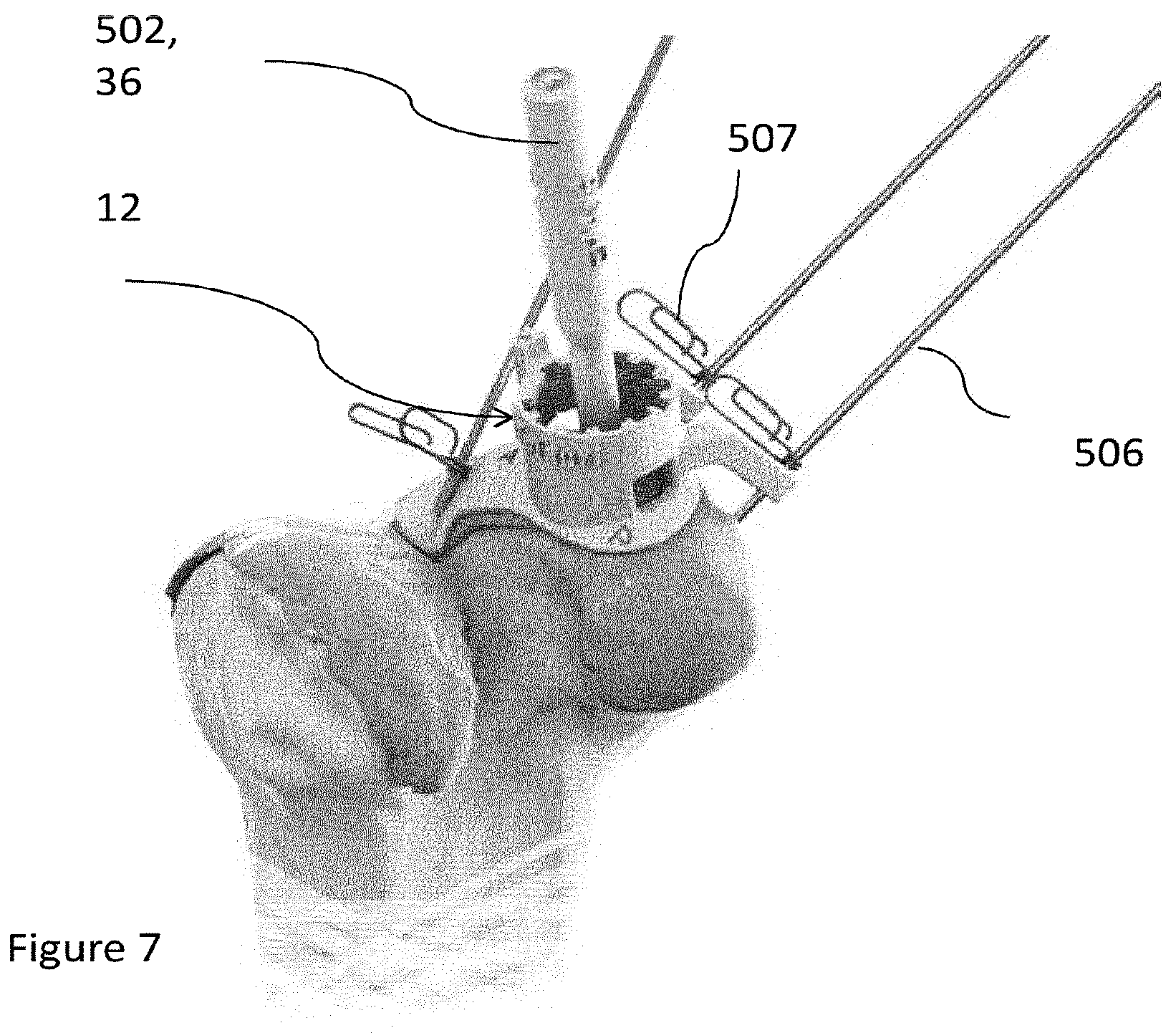 Patent US12102540 Figure 7 – System of designing a guide tool and/or surgical kit tools and/or an implant comprising a positioning mark