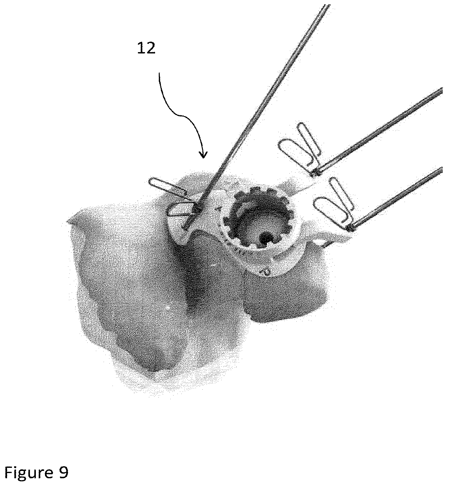 Patent US12102540 Figure 9 – System of designing a guide tool and/or surgical kit tools and/or an implant comprising a positioning mark
