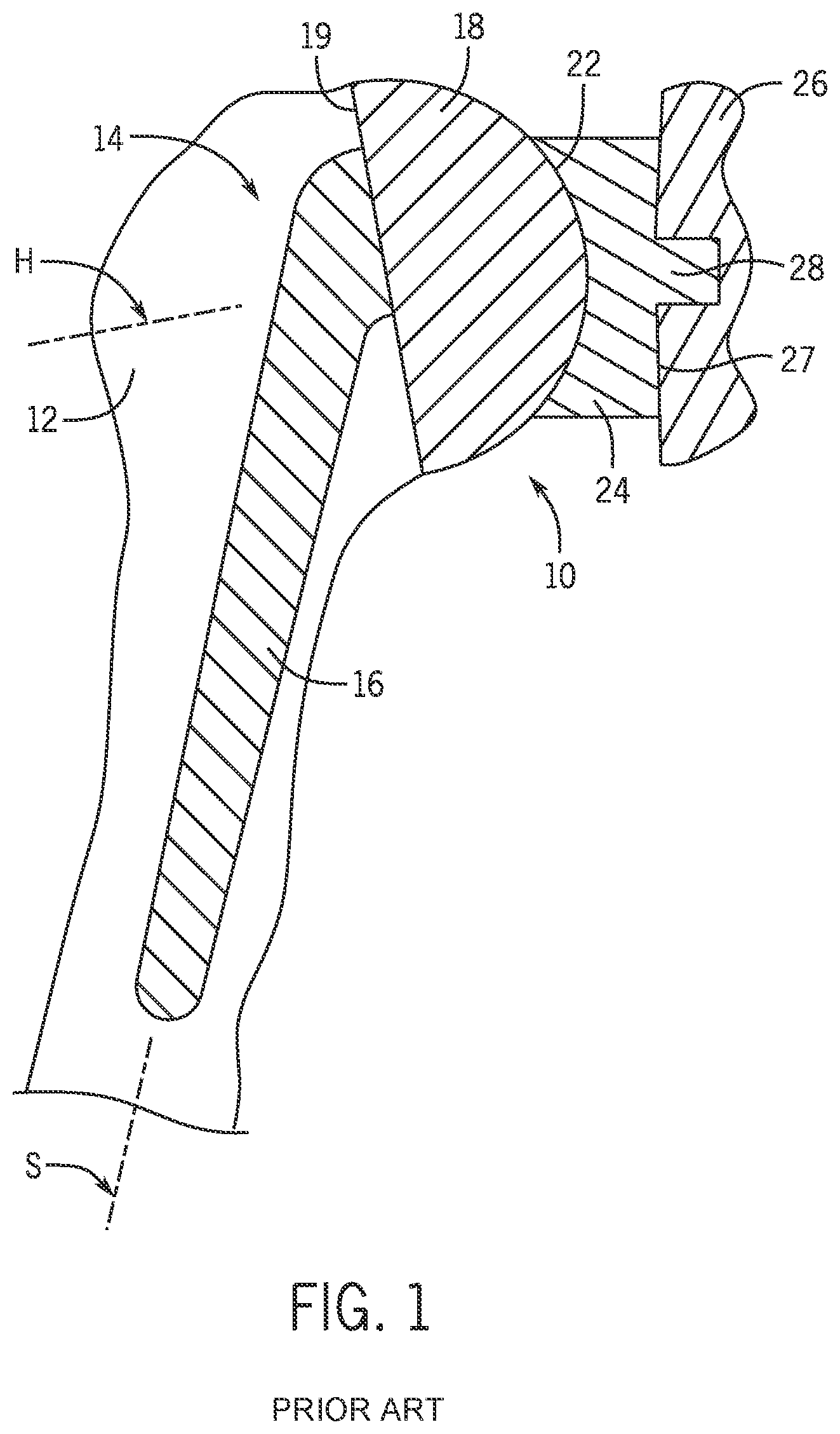 Patent US12102541 Figure 1 – Shoulder prosthesis with variable inclination humeral head component