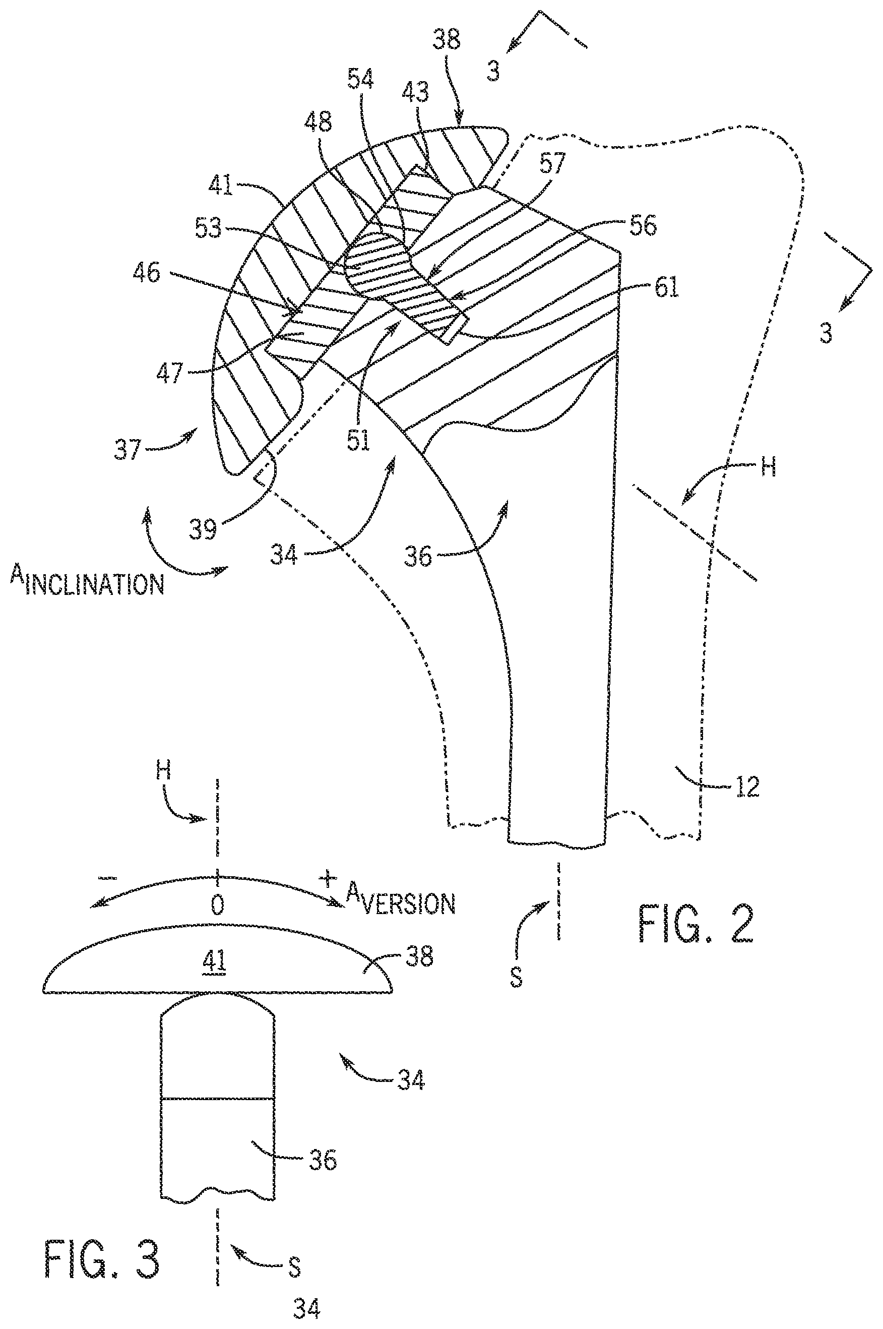 Patent US12102541 Figure 2 – Shoulder prosthesis with variable inclination humeral head component