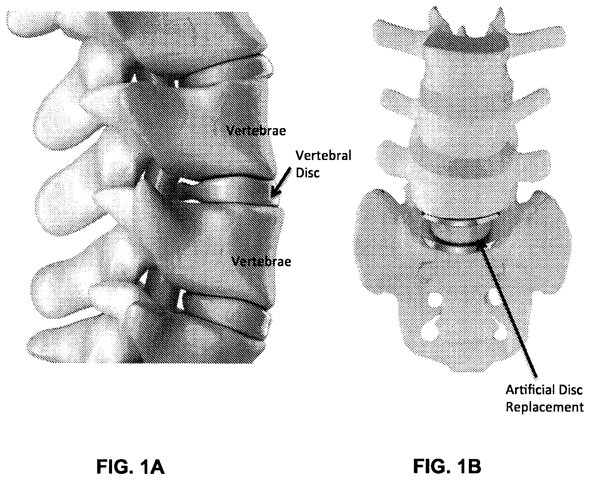 Patent US12102544 Figure 1 – Bio-mechanically compatible 3D-printed intervertebral disk