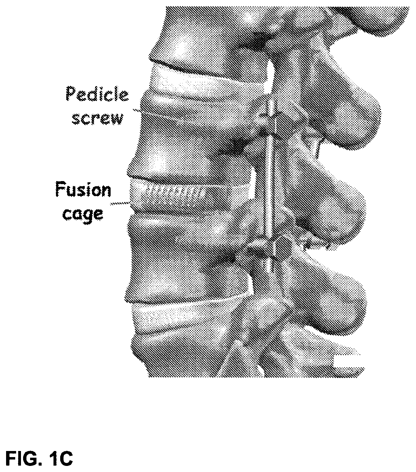 Patent US12102544 Figure 2 – Bio-mechanically compatible 3D-printed intervertebral disk