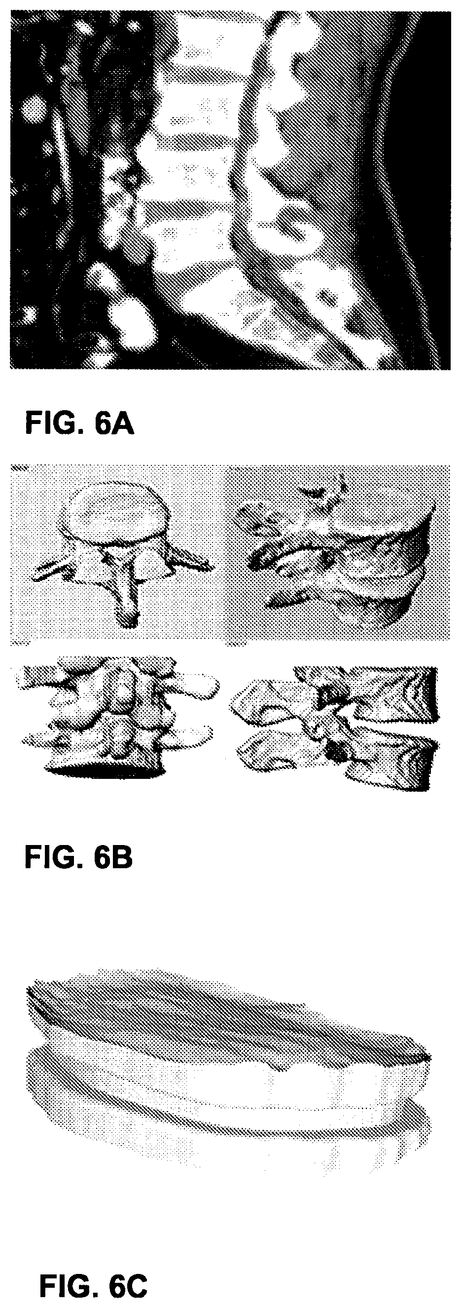 Patent US12102544 Figure 7 – Bio-mechanically compatible 3D-printed intervertebral disk