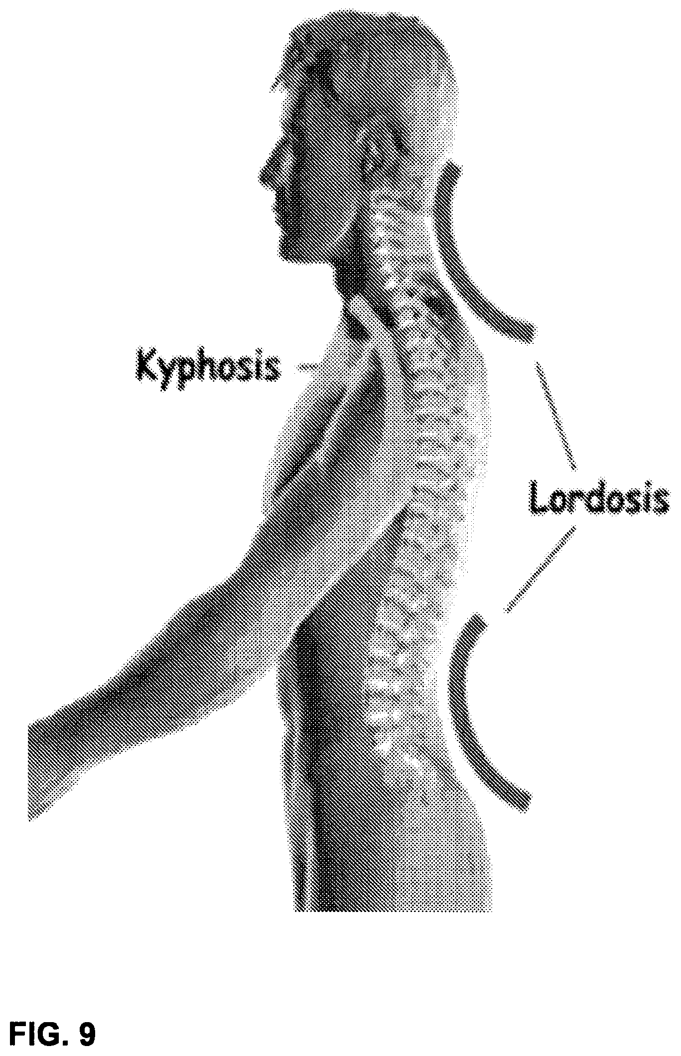 Patent US12102544 Figure 10 – Bio-mechanically compatible 3D-printed intervertebral disk