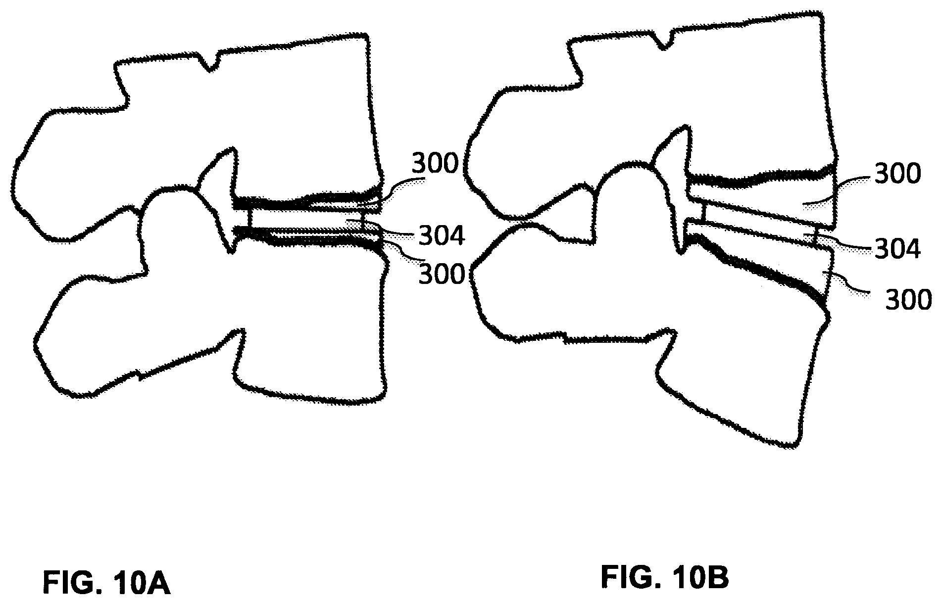 Patent US12102544 Figure 11 – Bio-mechanically compatible 3D-printed intervertebral disk