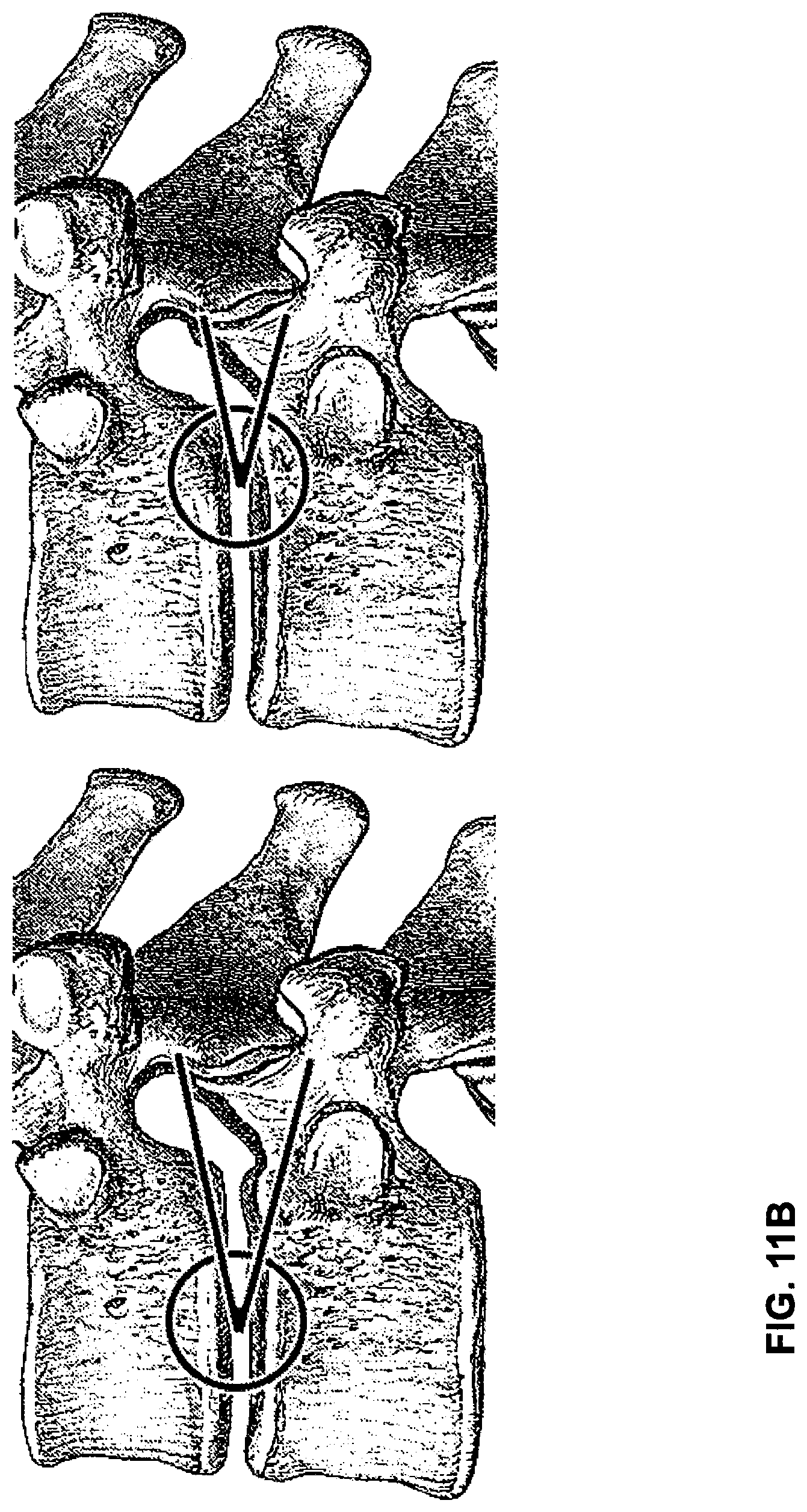 Patent US12102544 Figure 13 – Bio-mechanically compatible 3D-printed intervertebral disk