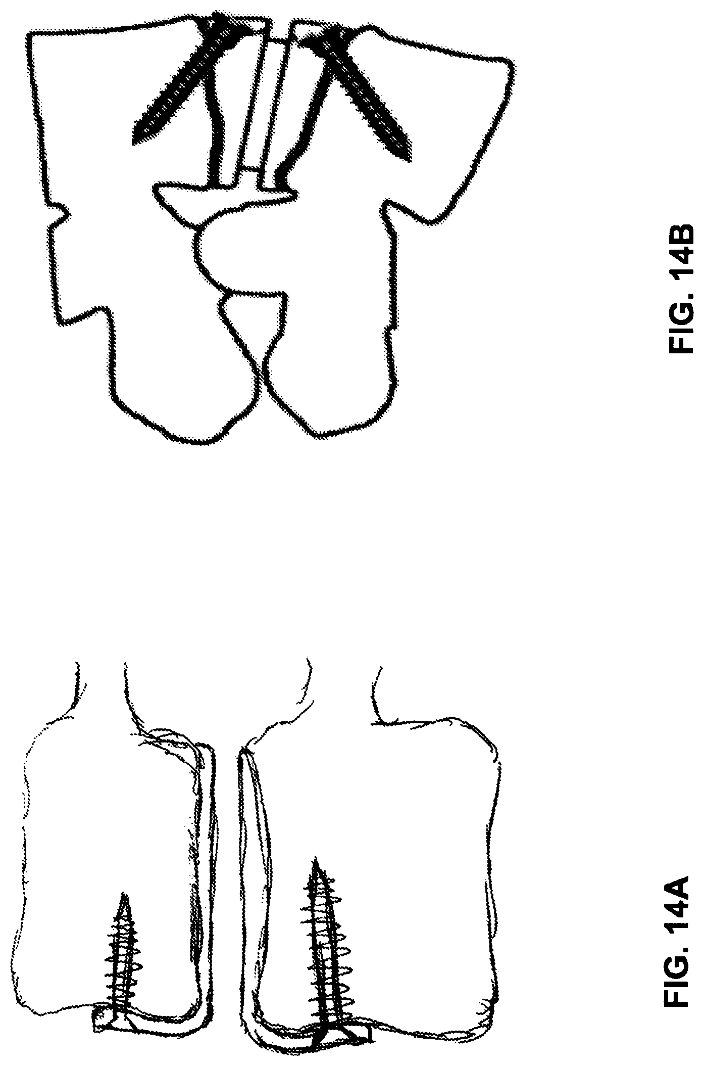 Patent US12102544 Figure 16 – Bio-mechanically compatible 3D-printed intervertebral disk