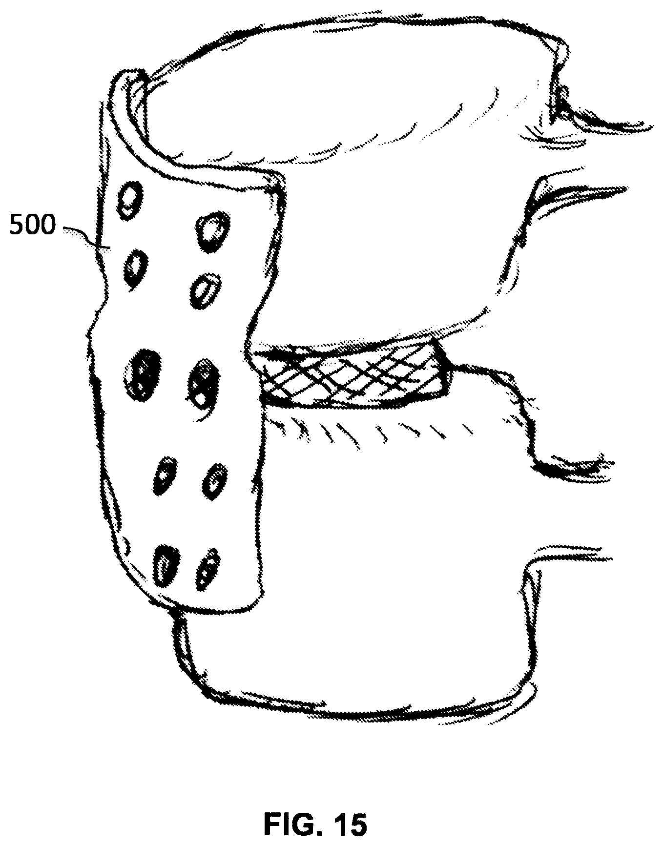 Patent US12102544 Figure 17 – Bio-mechanically compatible 3D-printed intervertebral disk