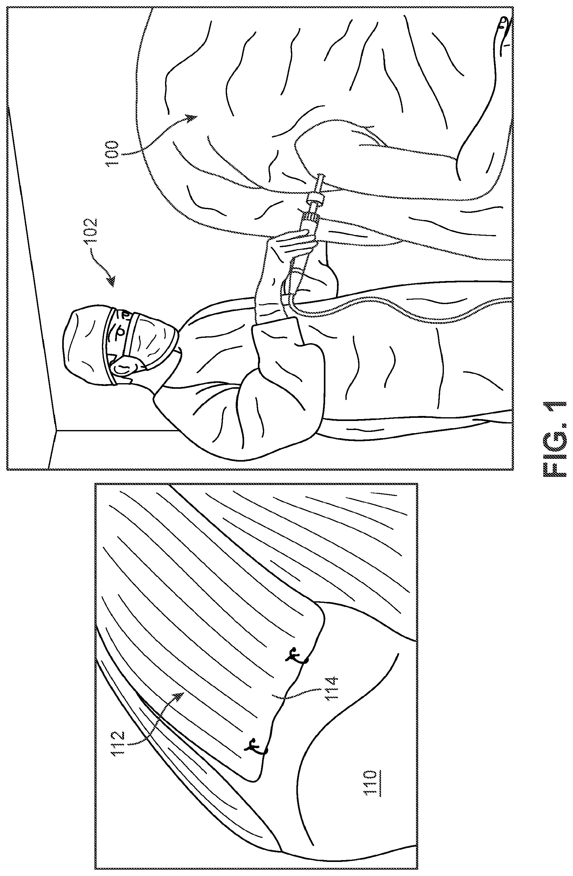 Patent US12102545 Figure 1 – Implant delivery device