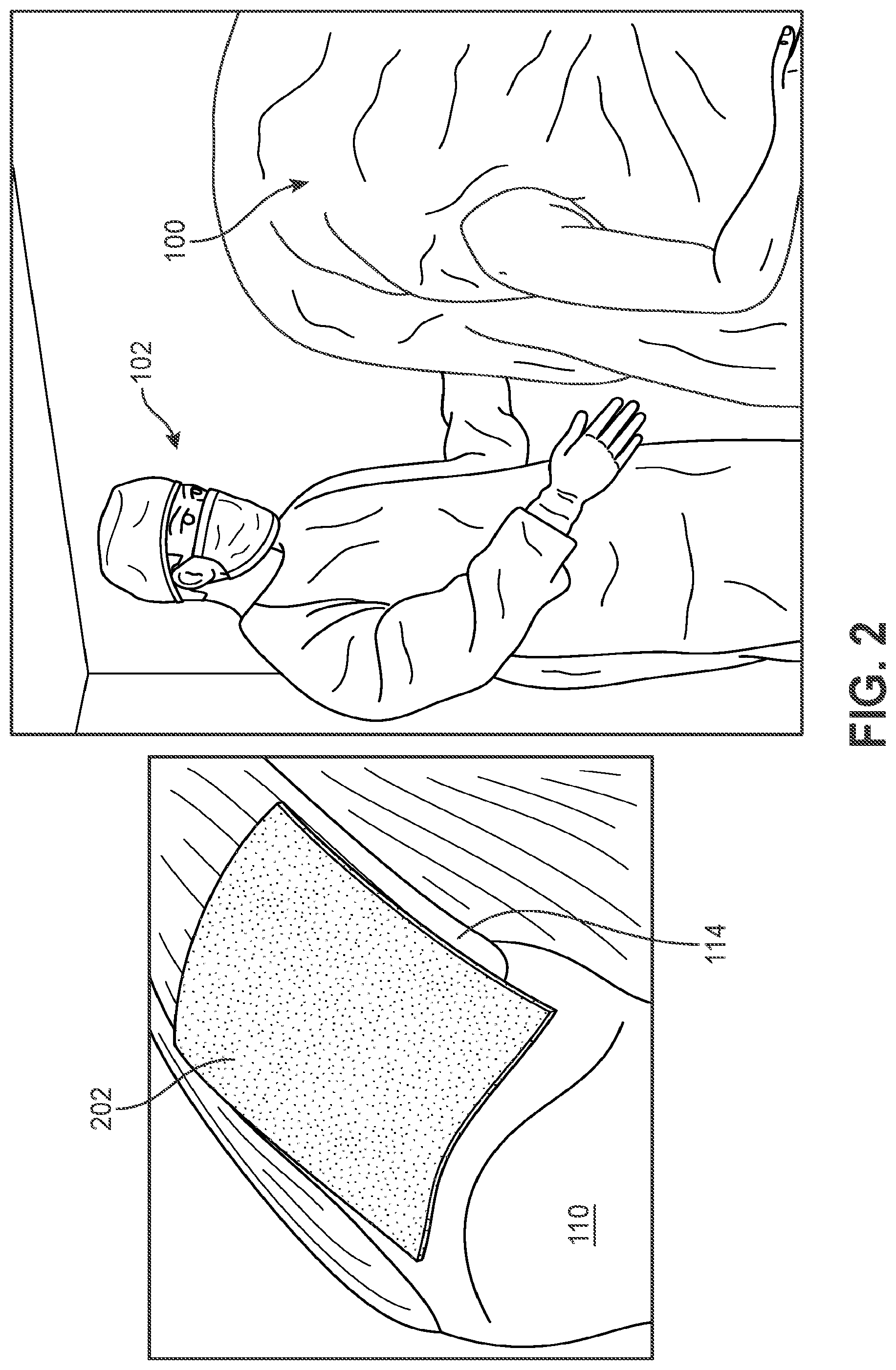 Patent US12102545 Figure 2 – Implant delivery device