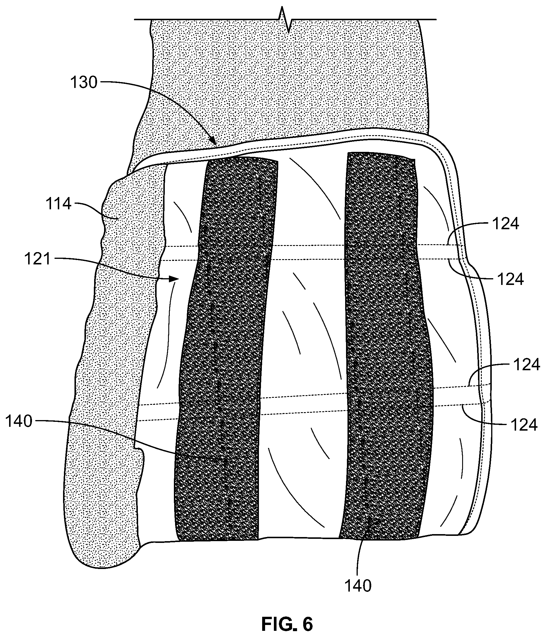 Patent US12102548 Figure 5 – Leg protector for above-knee amputation