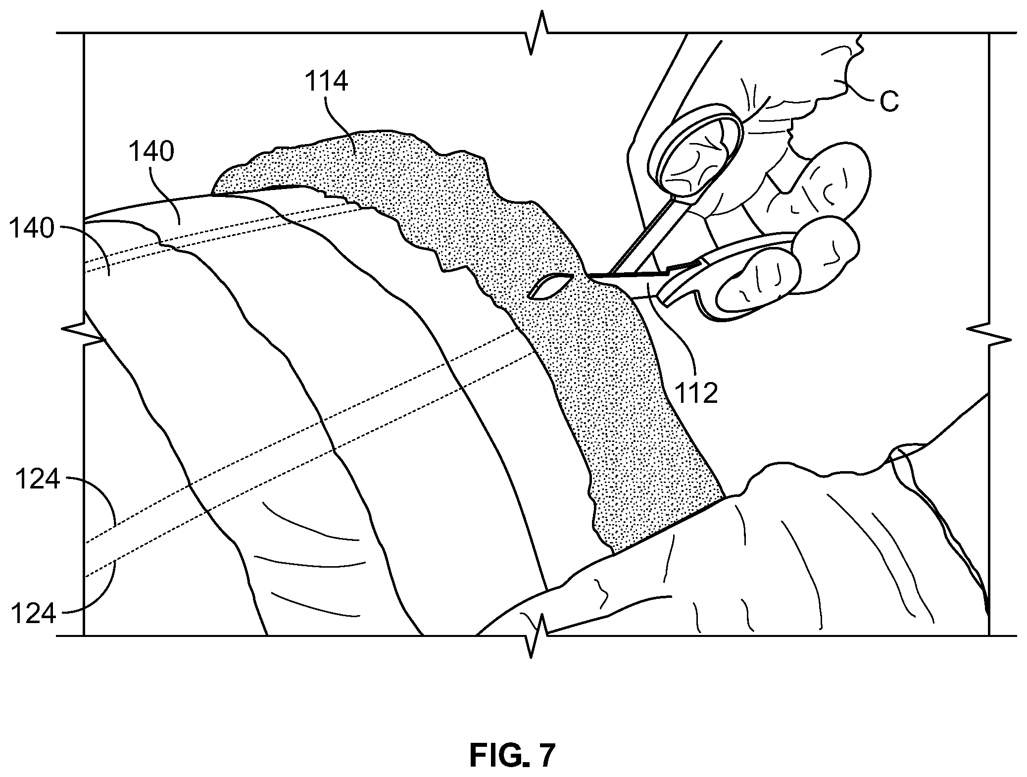 Patent US12102548 Figure 6 – Leg protector for above-knee amputation