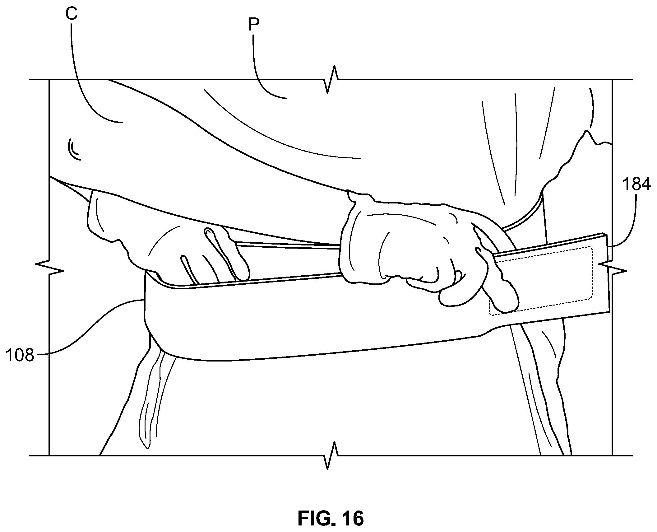 Patent US12102548 Figure 13 – Leg protector for above-knee amputation