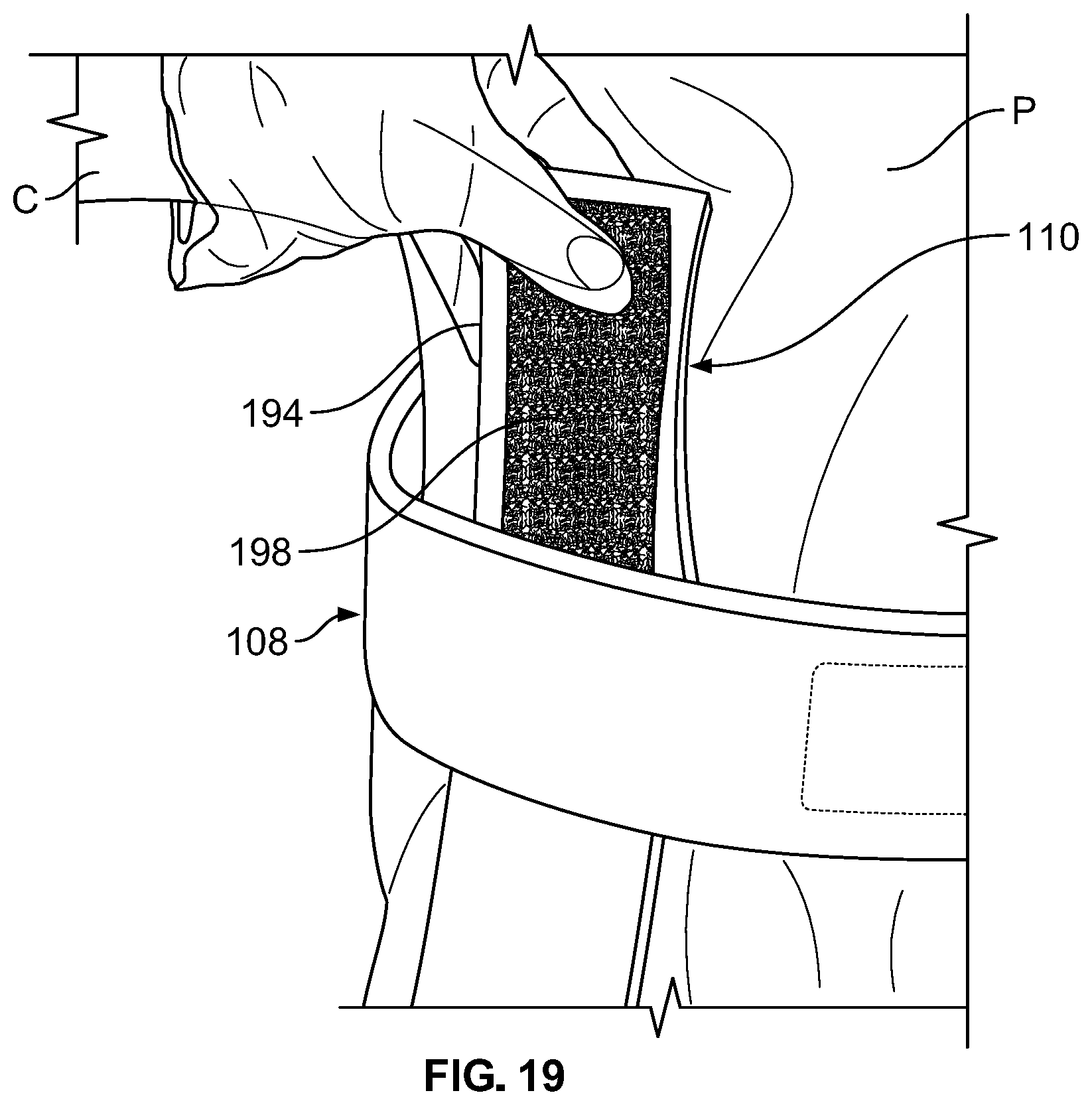 Patent US12102548 Figure 15 – Leg protector for above-knee amputation