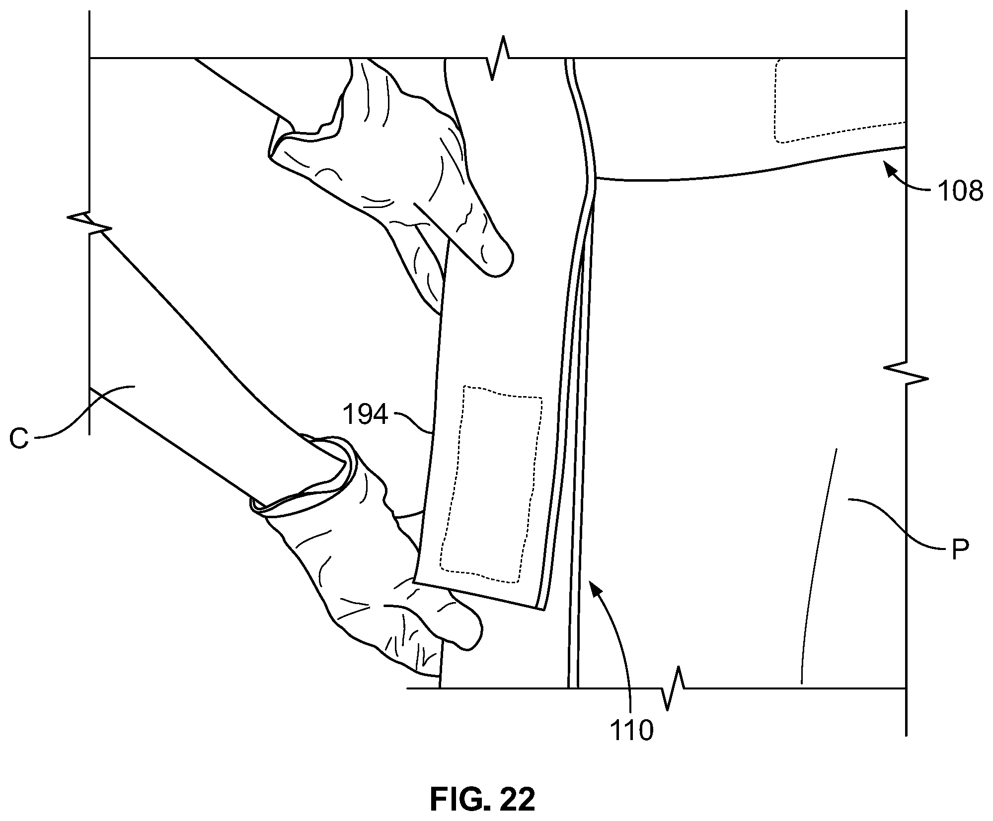 Patent US12102548 Figure 17 – Leg protector for above-knee amputation