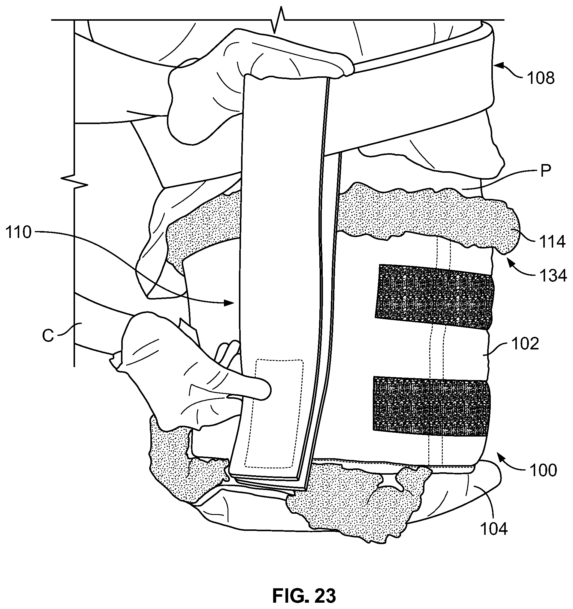 Patent US12102548 Figure 18 – Leg protector for above-knee amputation