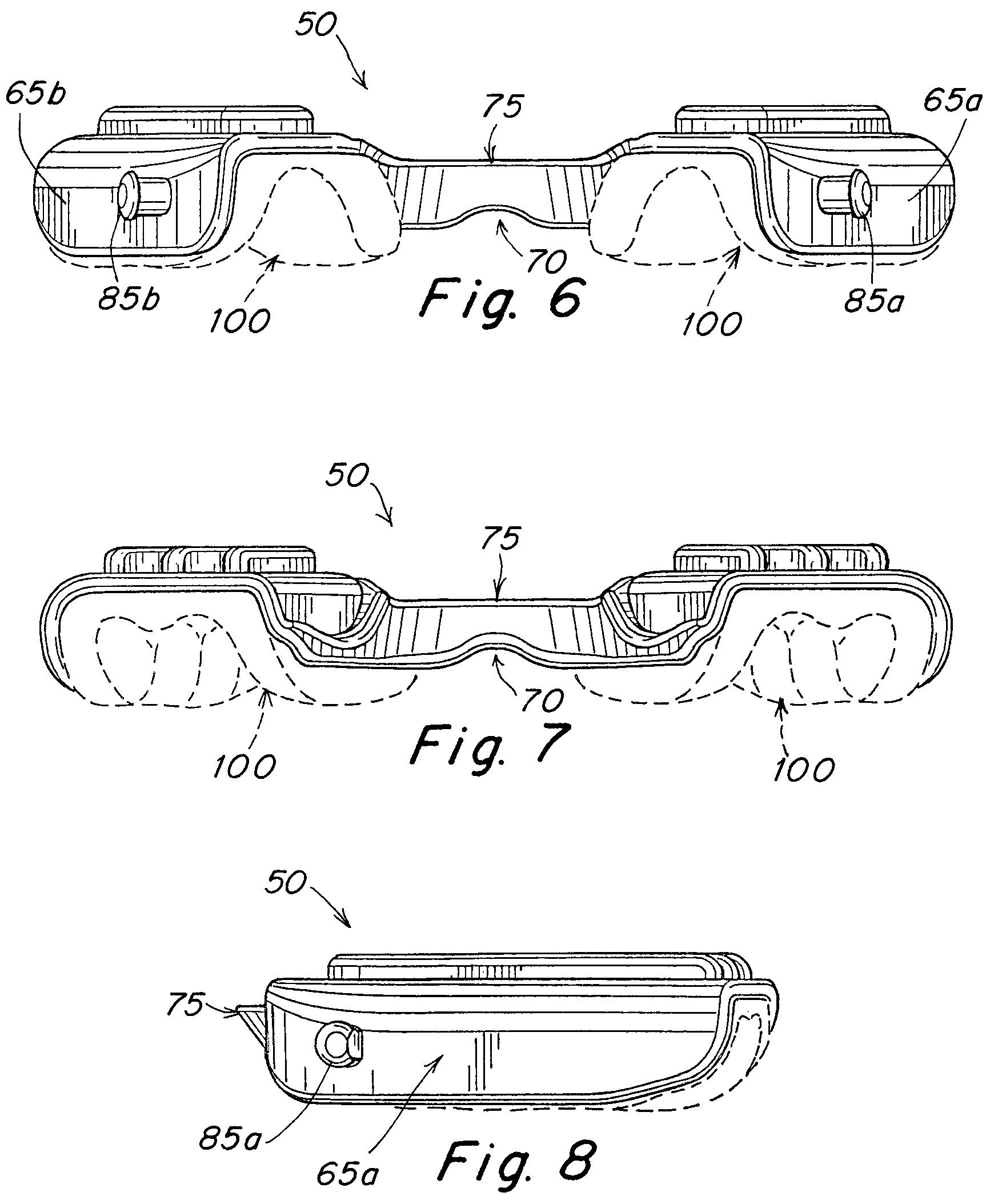 Patent US12102555 Figure 3 – Oral appliance