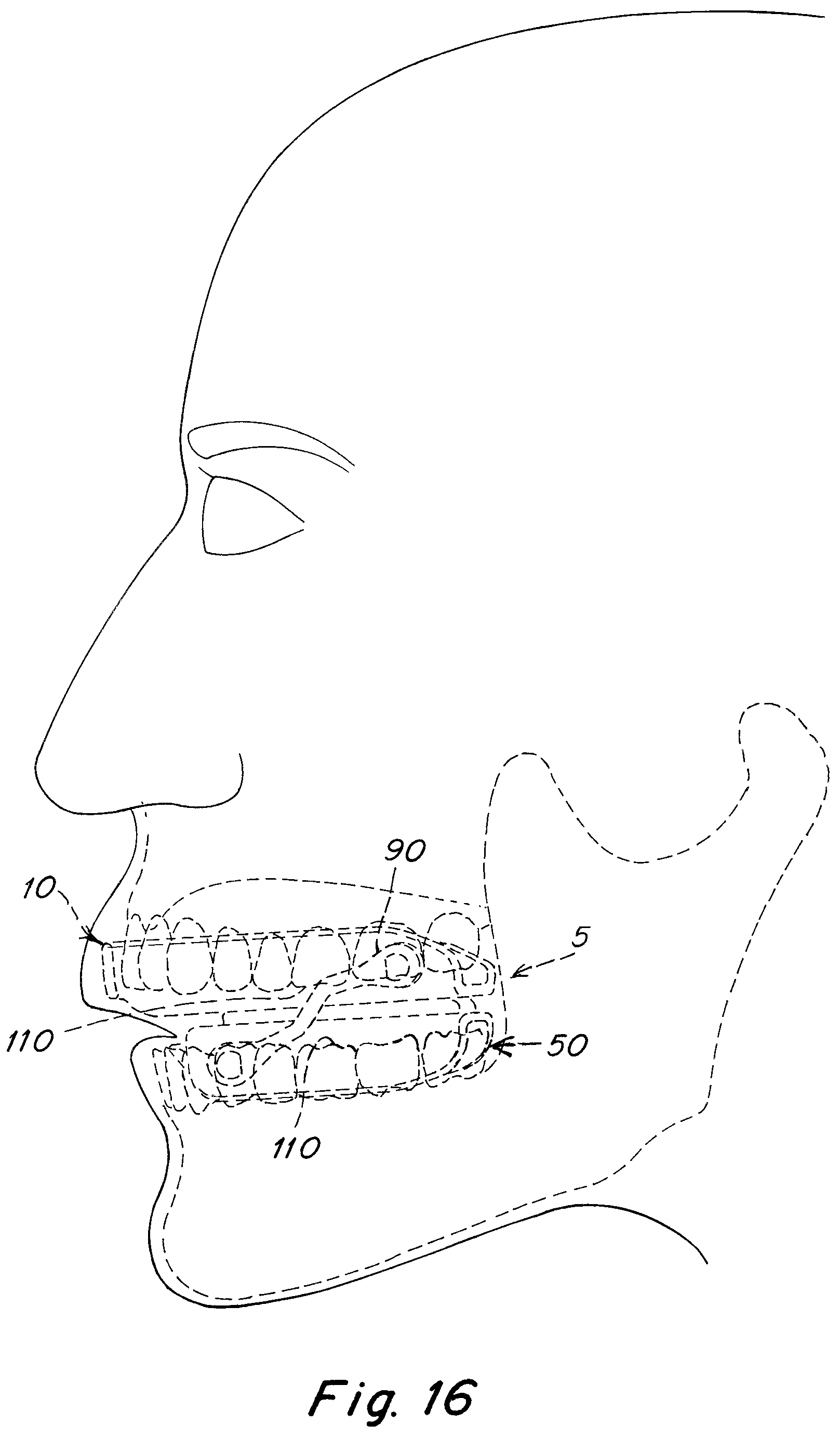 Patent US12102555 Figure 7 – Oral appliance