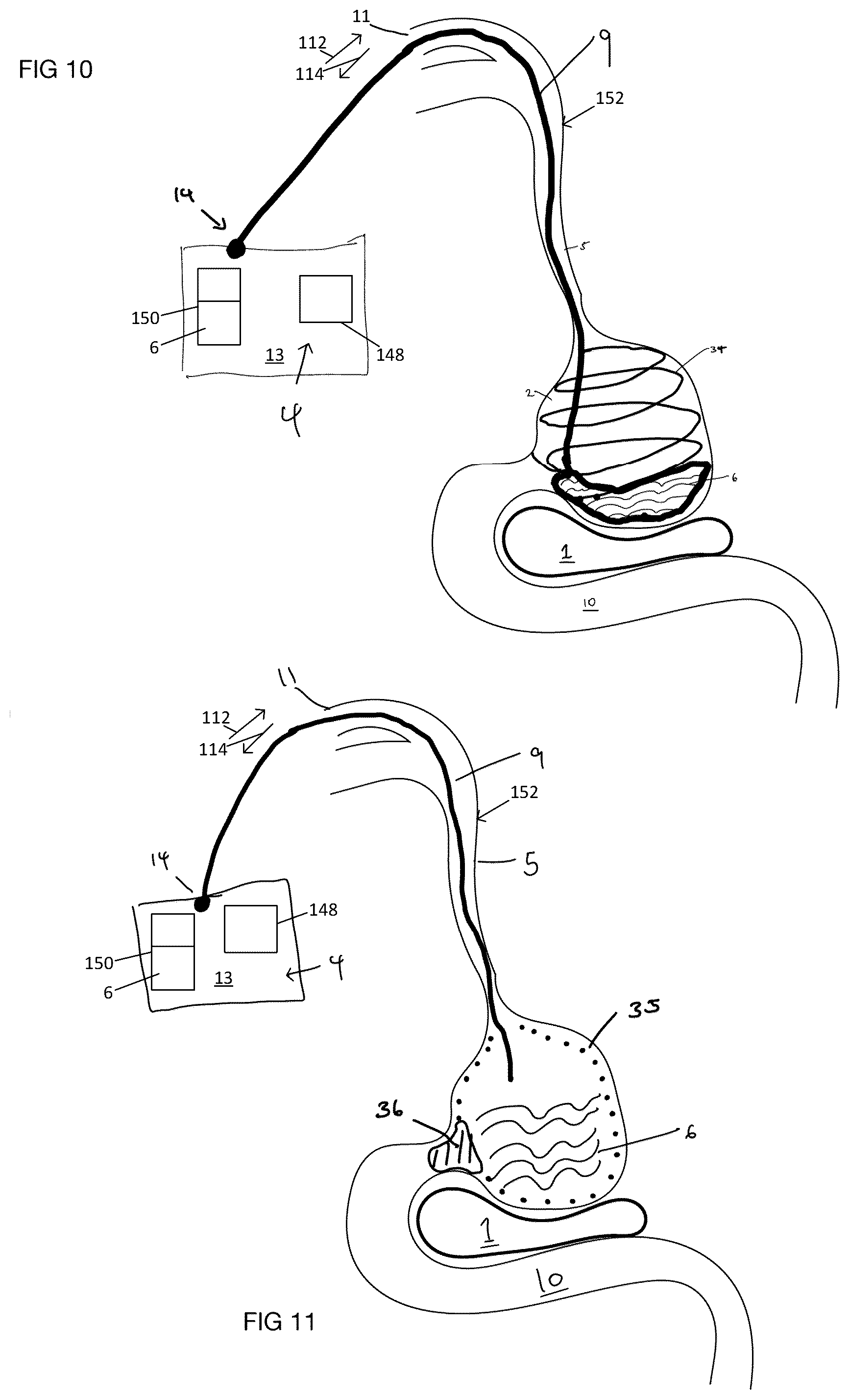 Patent US12102558 Figure 5 – Apparatus and method for cooling and/or heating an organ