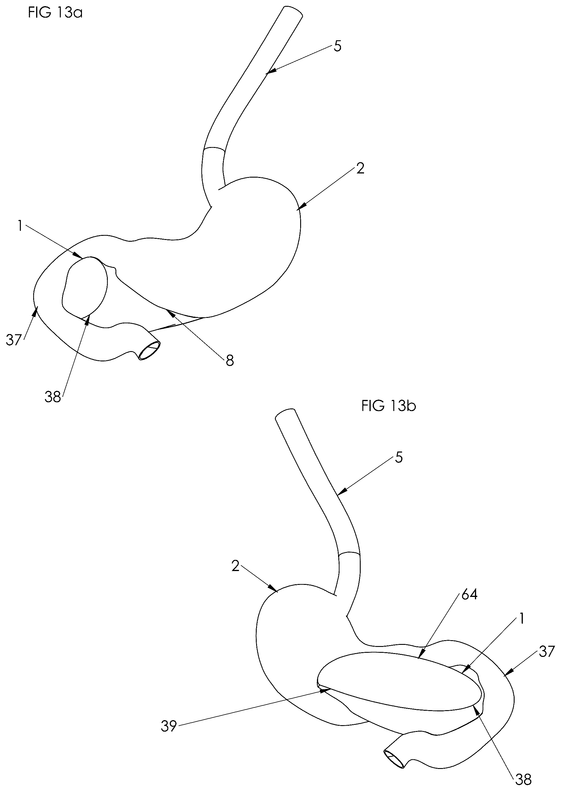 Patent US12102558 Figure 7 – Apparatus and method for cooling and/or heating an organ