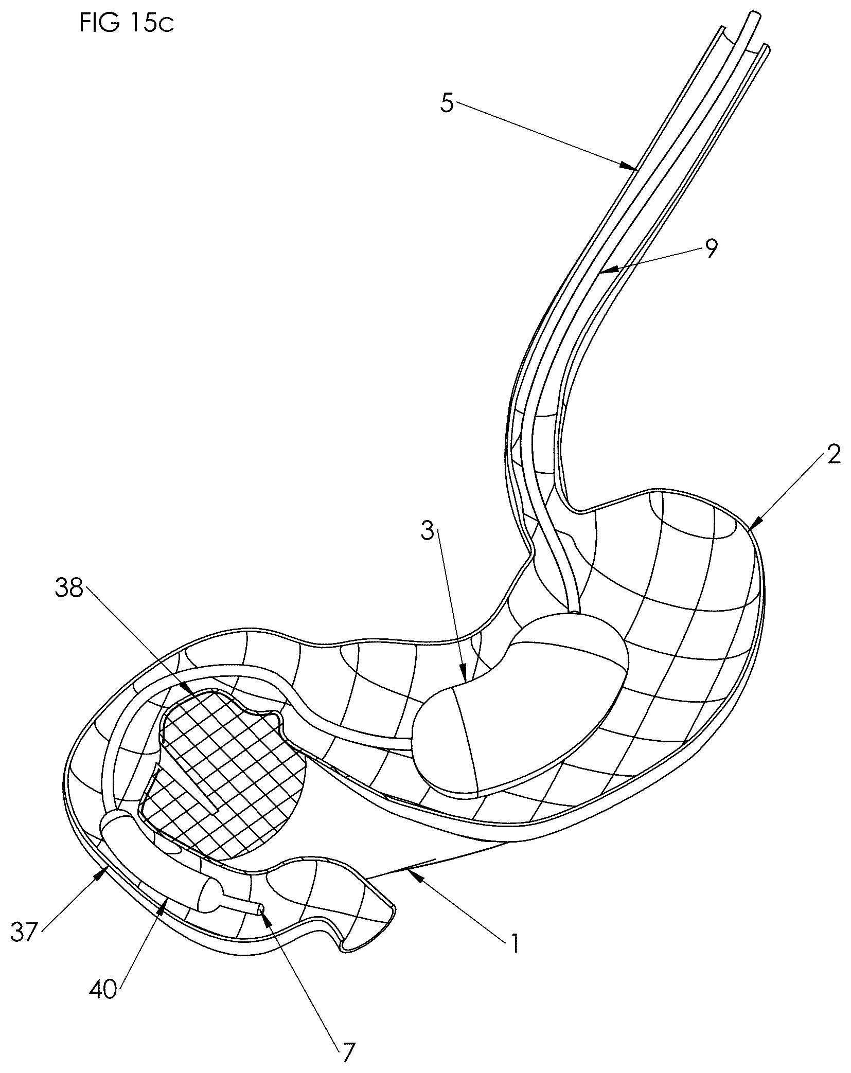 Patent US12102558 Figure 12 – Apparatus and method for cooling and/or heating an organ