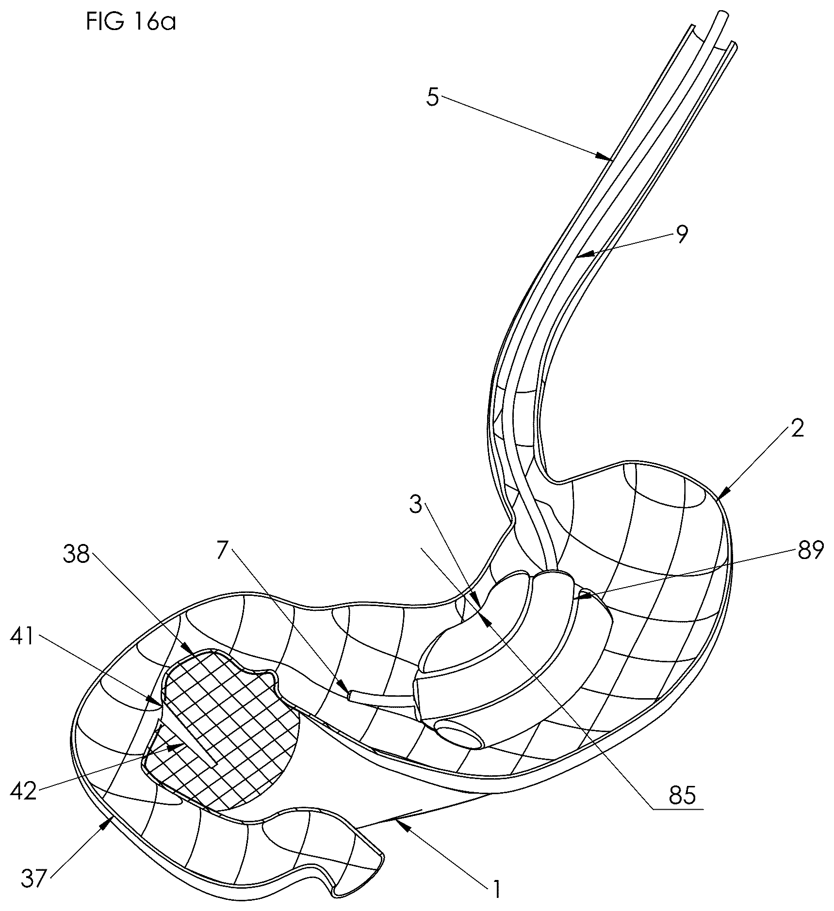 Patent US12102558 Figure 13 – Apparatus and method for cooling and/or heating an organ