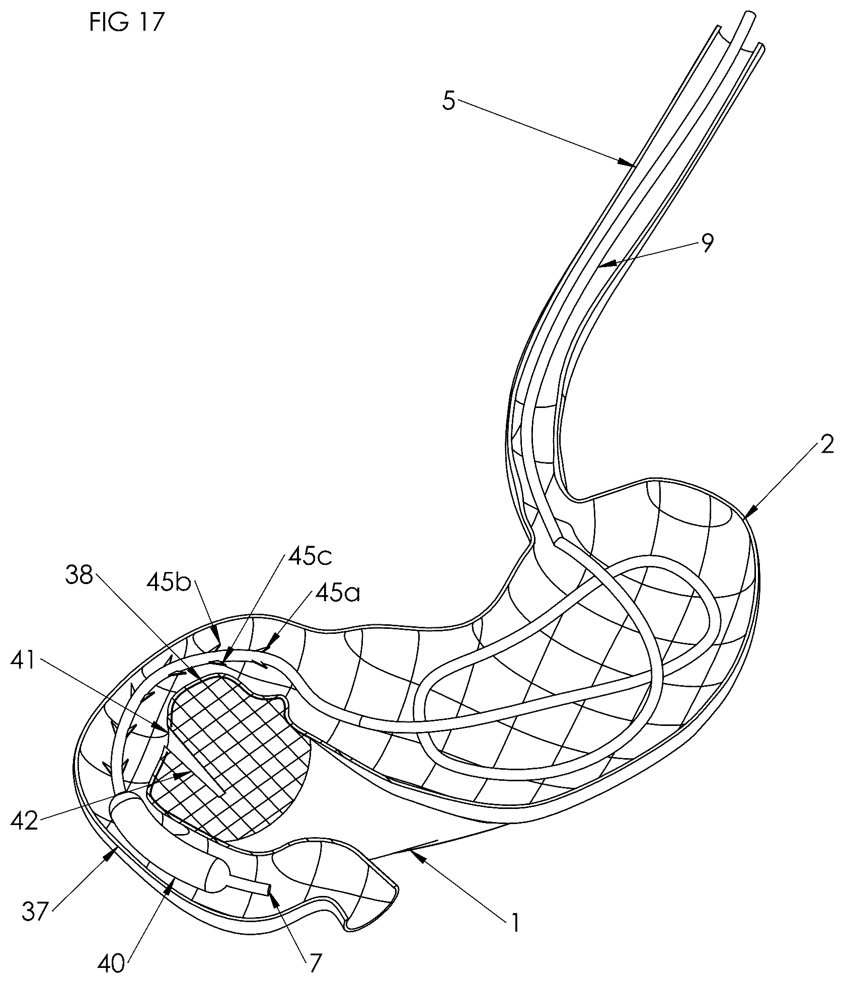 Patent US12102558 Figure 16 – Apparatus and method for cooling and/or heating an organ