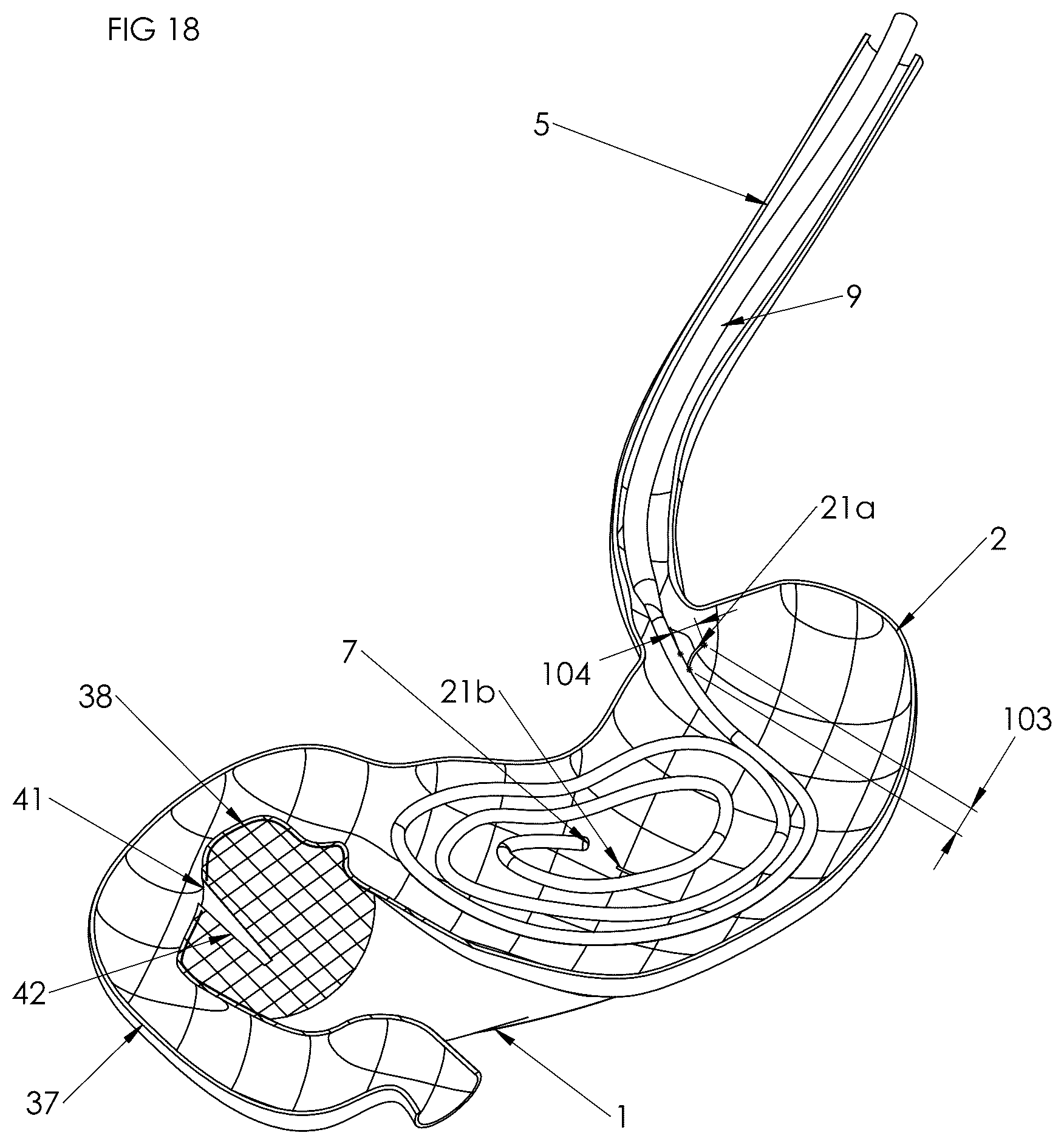 Patent US12102558 Figure 17 – Apparatus and method for cooling and/or heating an organ