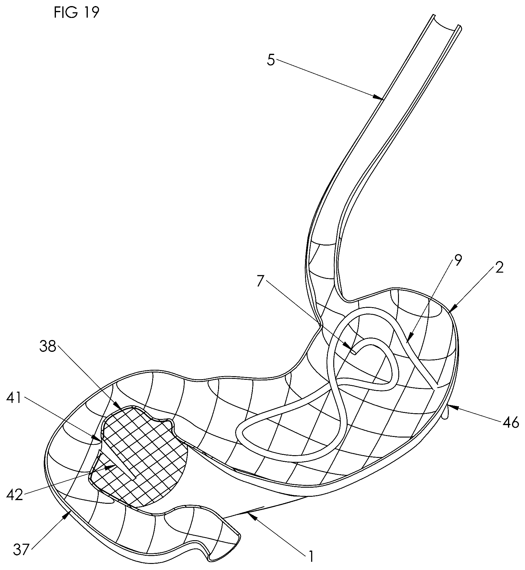 Patent US12102558 Figure 18 – Apparatus and method for cooling and/or heating an organ