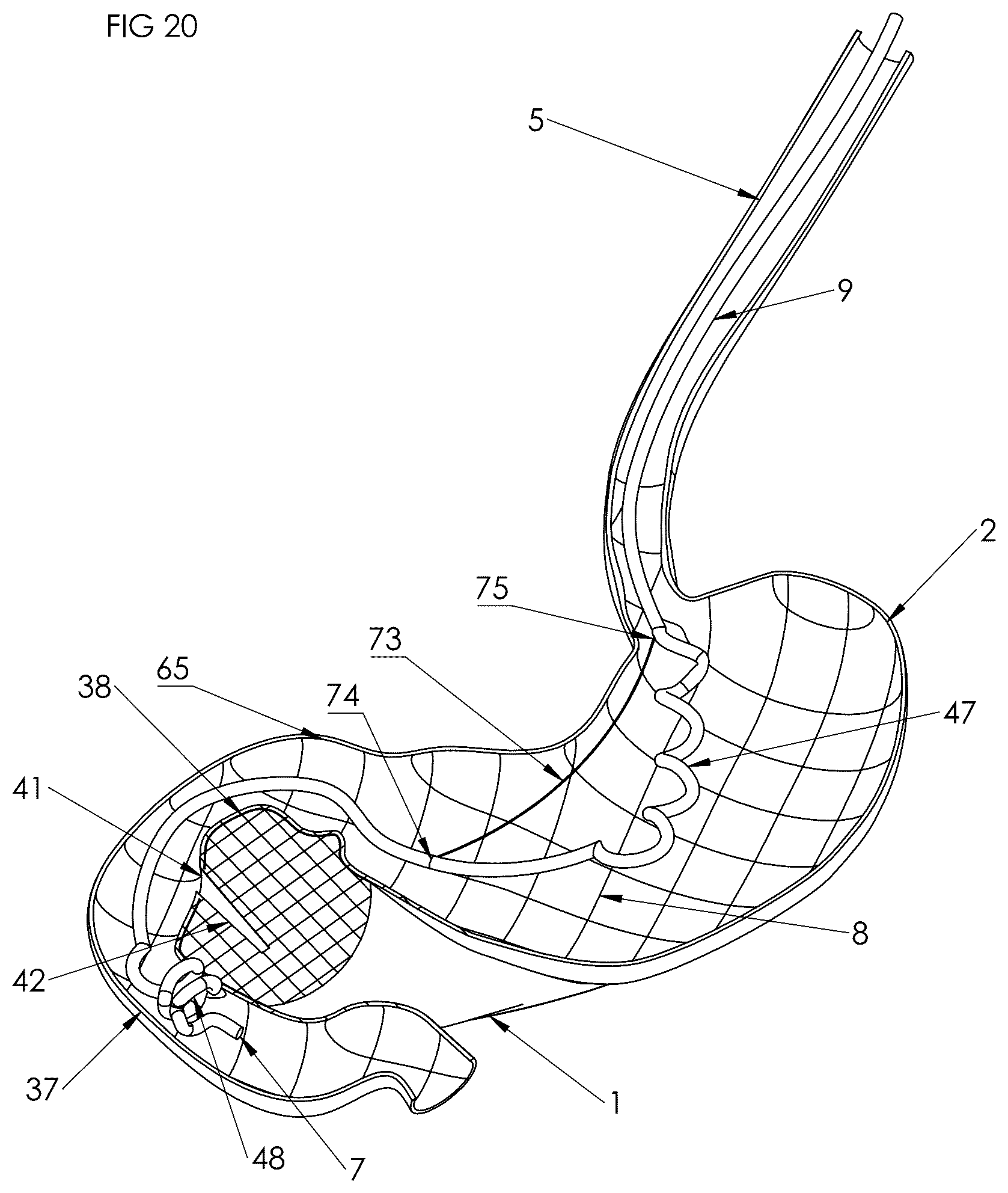 Patent US12102558 Figure 19 – Apparatus and method for cooling and/or heating an organ
