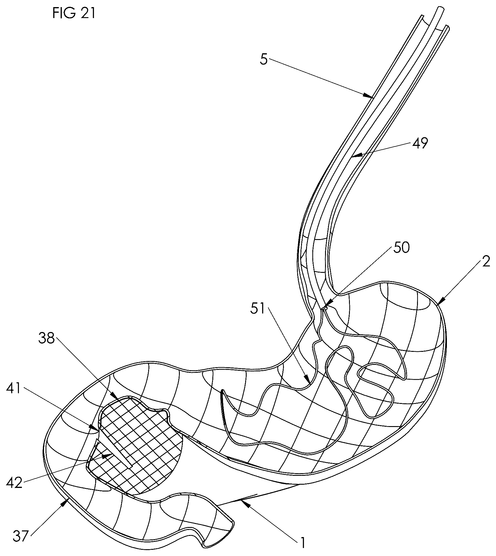 Patent US12102558 Figure 20 – Apparatus and method for cooling and/or heating an organ