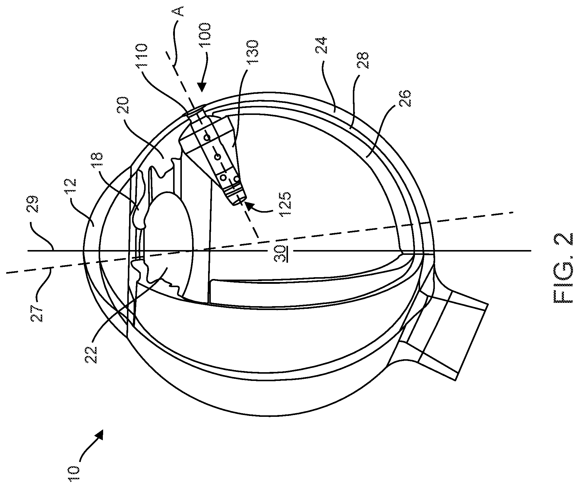 Patent US12102560 Figure 2 – Implantable ocular drug delivery devices