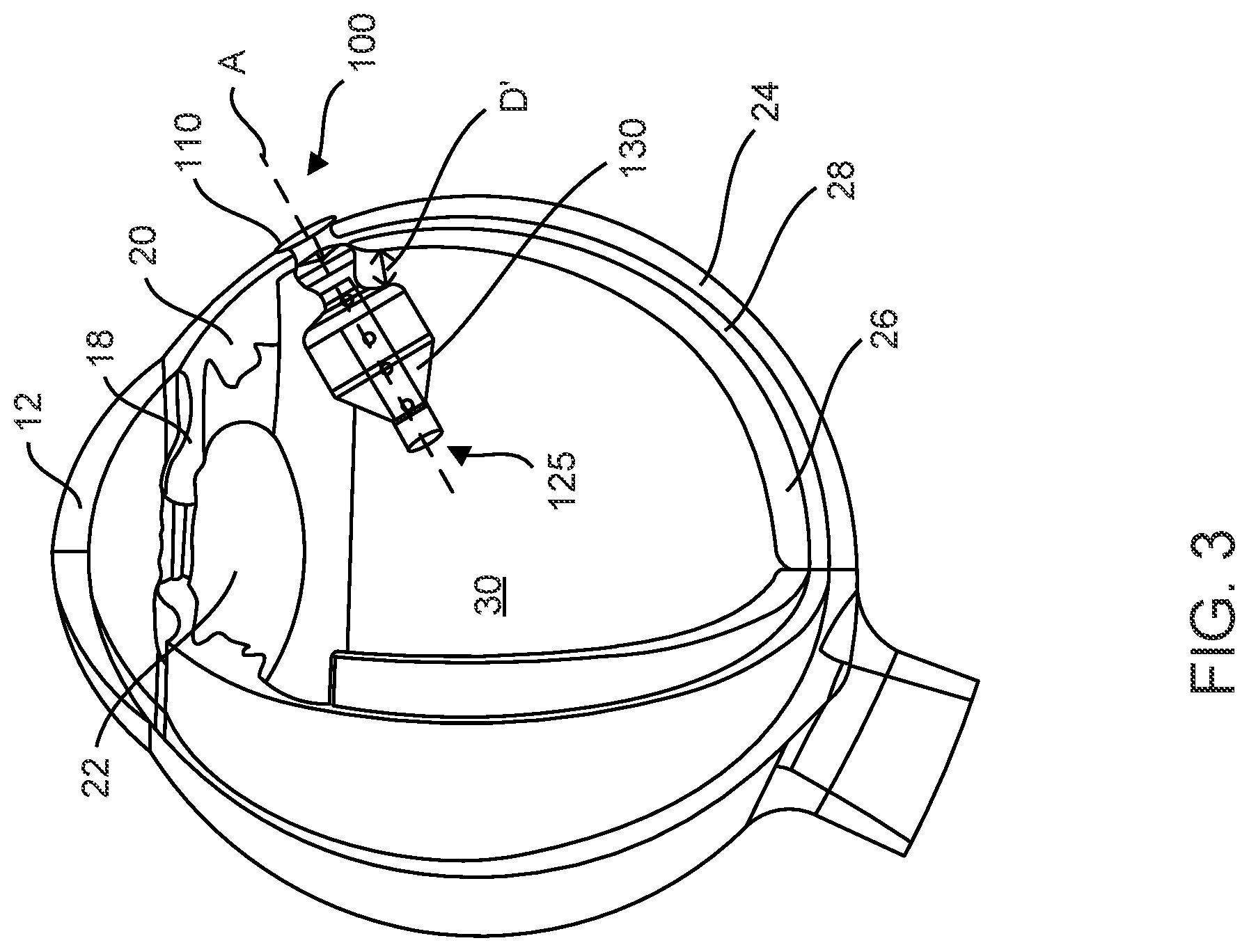 Patent US12102560 Figure 3 – Implantable ocular drug delivery devices