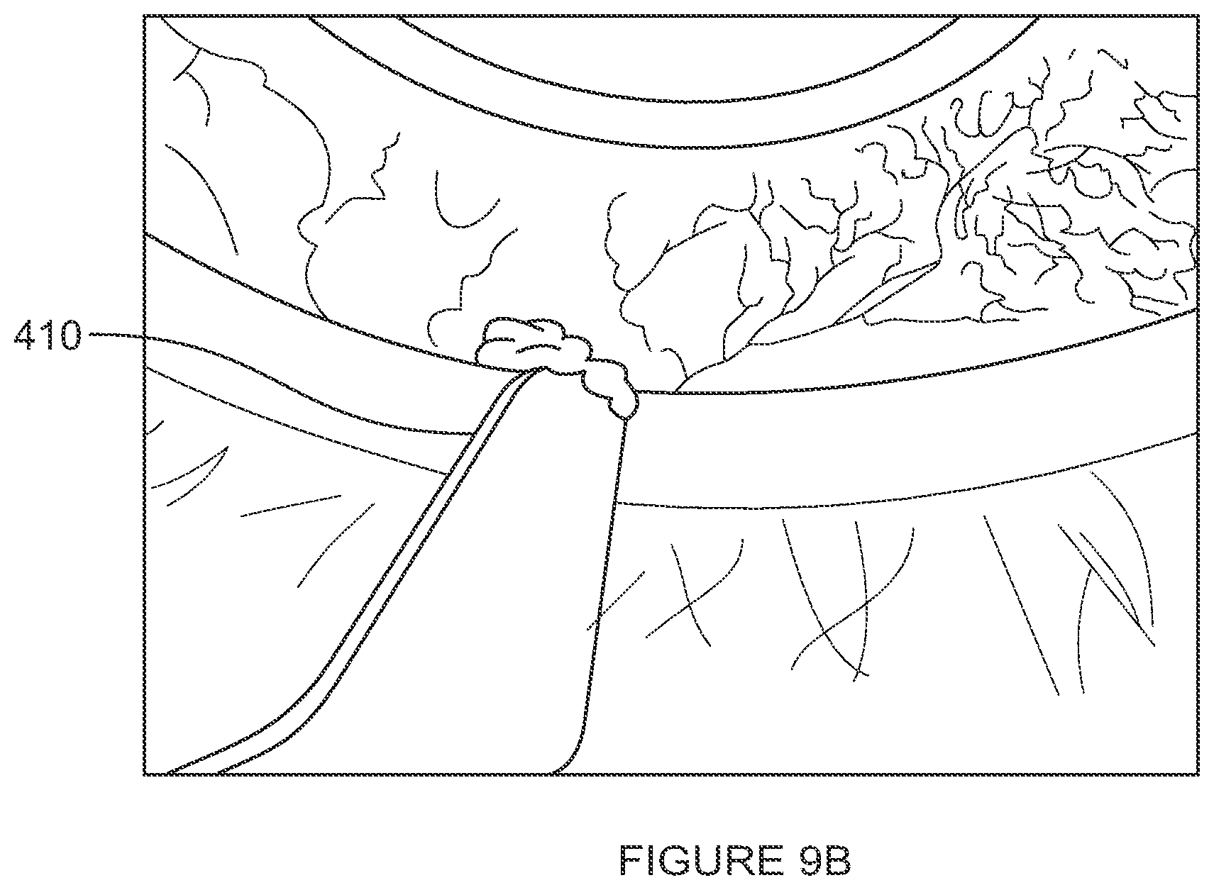 Patent US12102561 Figure 13 – Multi-modal thermal therapy for Blepharitis, Meibomian Gland Dysfunction and Dry Eye Syndrome