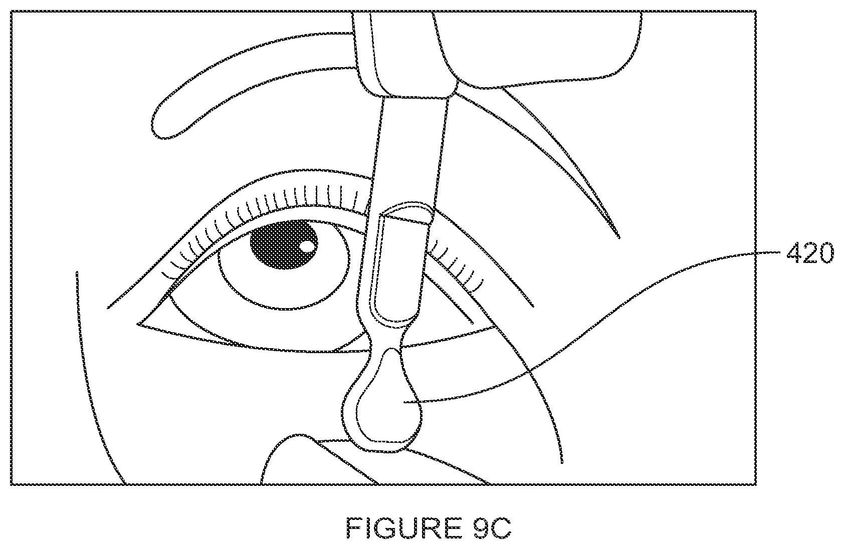 Patent US12102561 Figure 14 – Multi-modal thermal therapy for Blepharitis, Meibomian Gland Dysfunction and Dry Eye Syndrome
