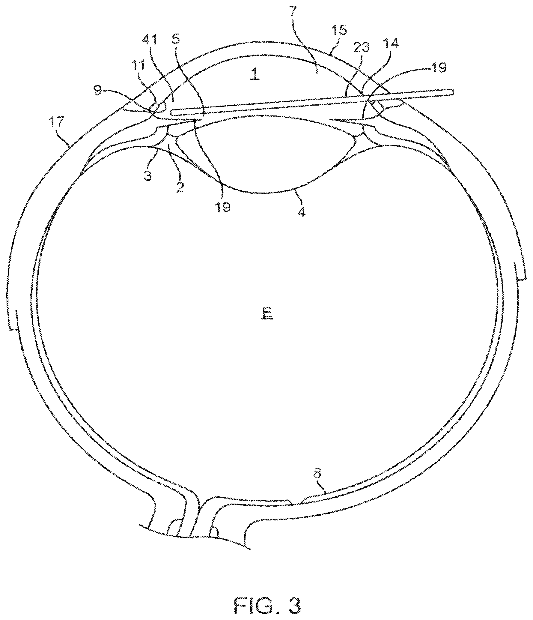 Patent US12102562 Figure 4 – Methods and systems for OCT guided glaucoma surgery