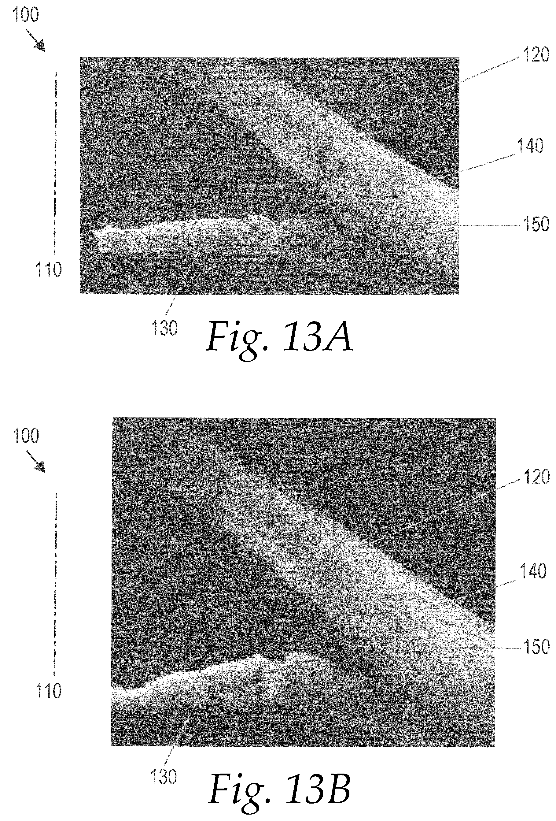 Patent US12102563 Figure 4 – Surgical instruments for anterior goniotomy