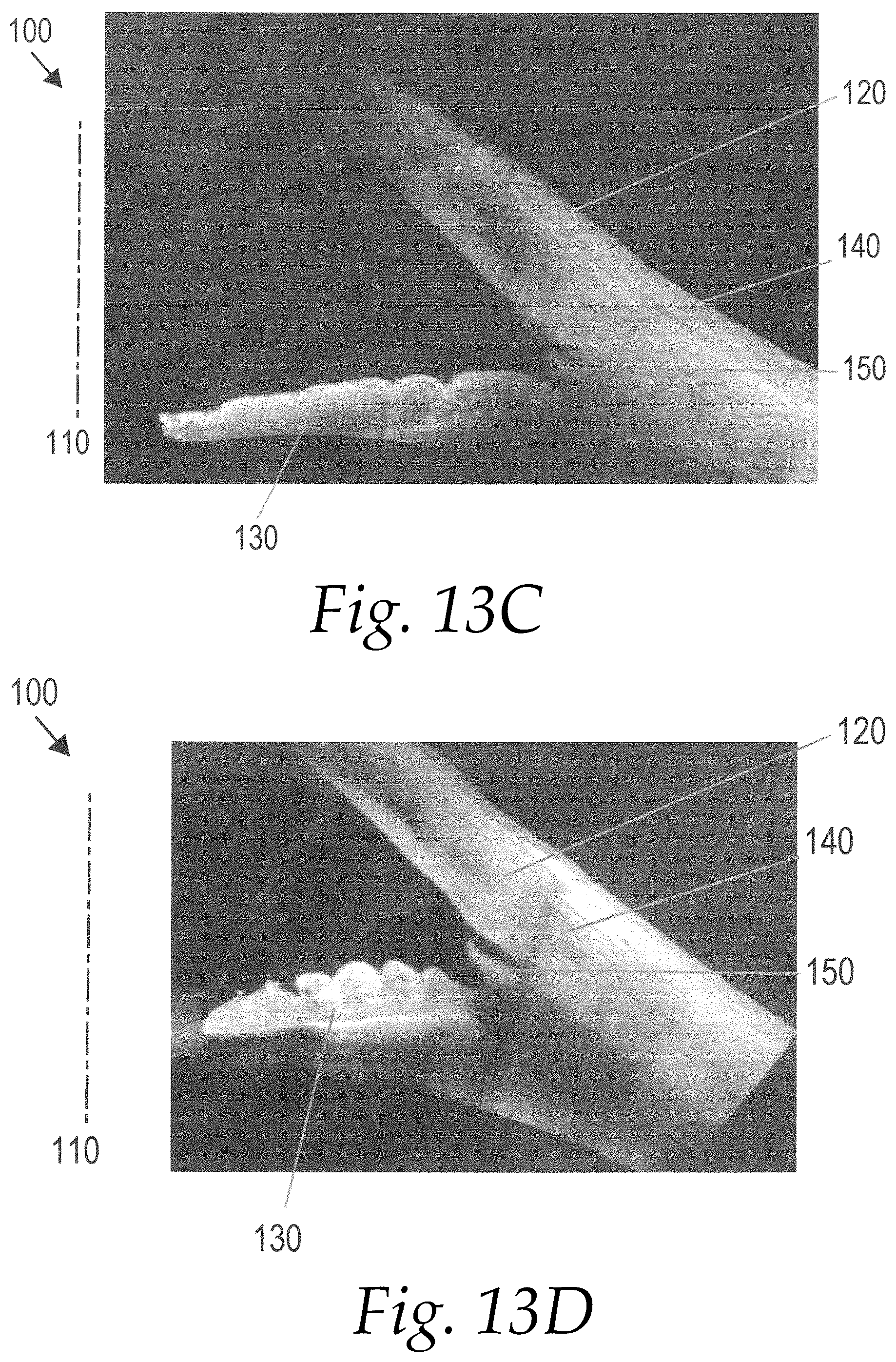 Patent US12102563 Figure 5 – Surgical instruments for anterior goniotomy