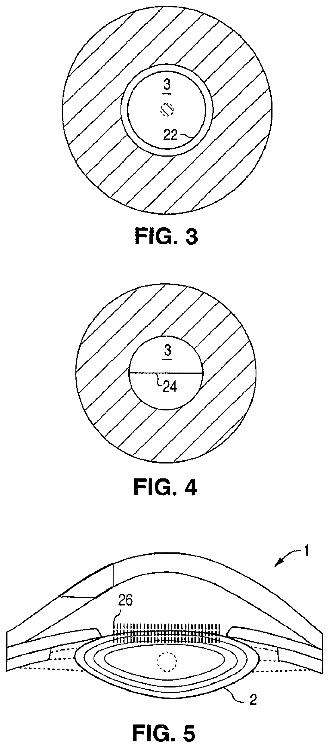 Patent US12102565 Figure 2 – Apparatus for patterned plasma-mediated laser ophthalmic surgery