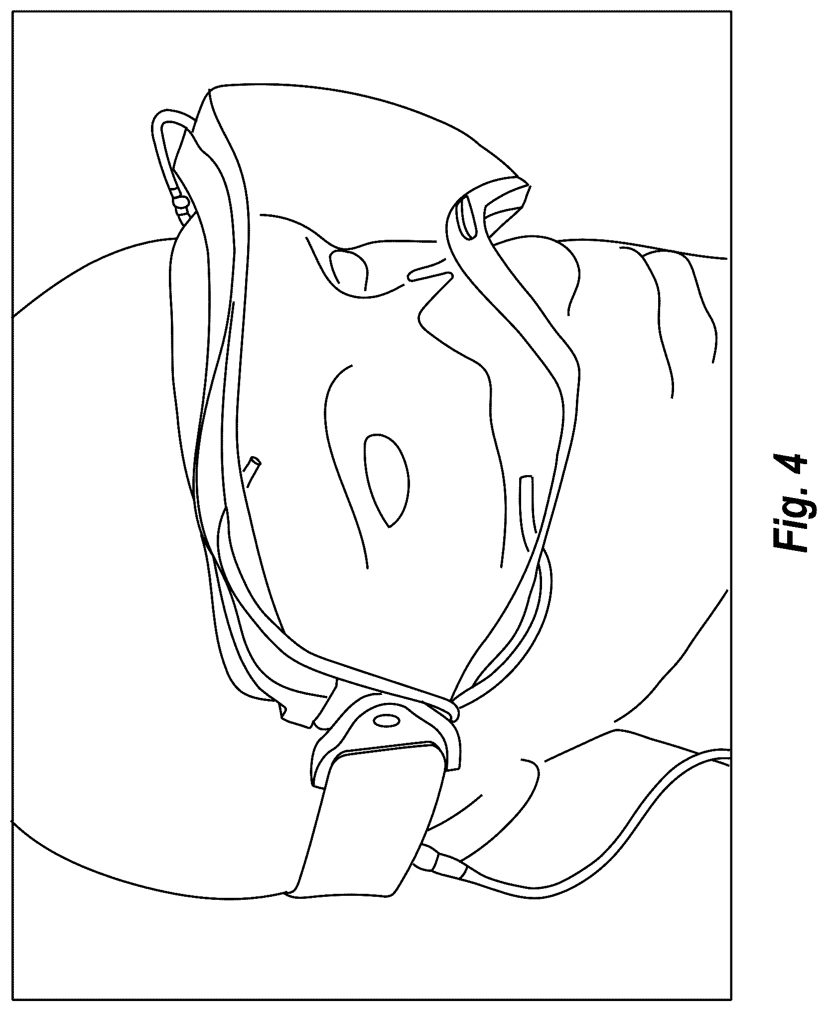 Patent US12102568 Figure 5 – Fog-reducing apparatus for eye protection equipment
